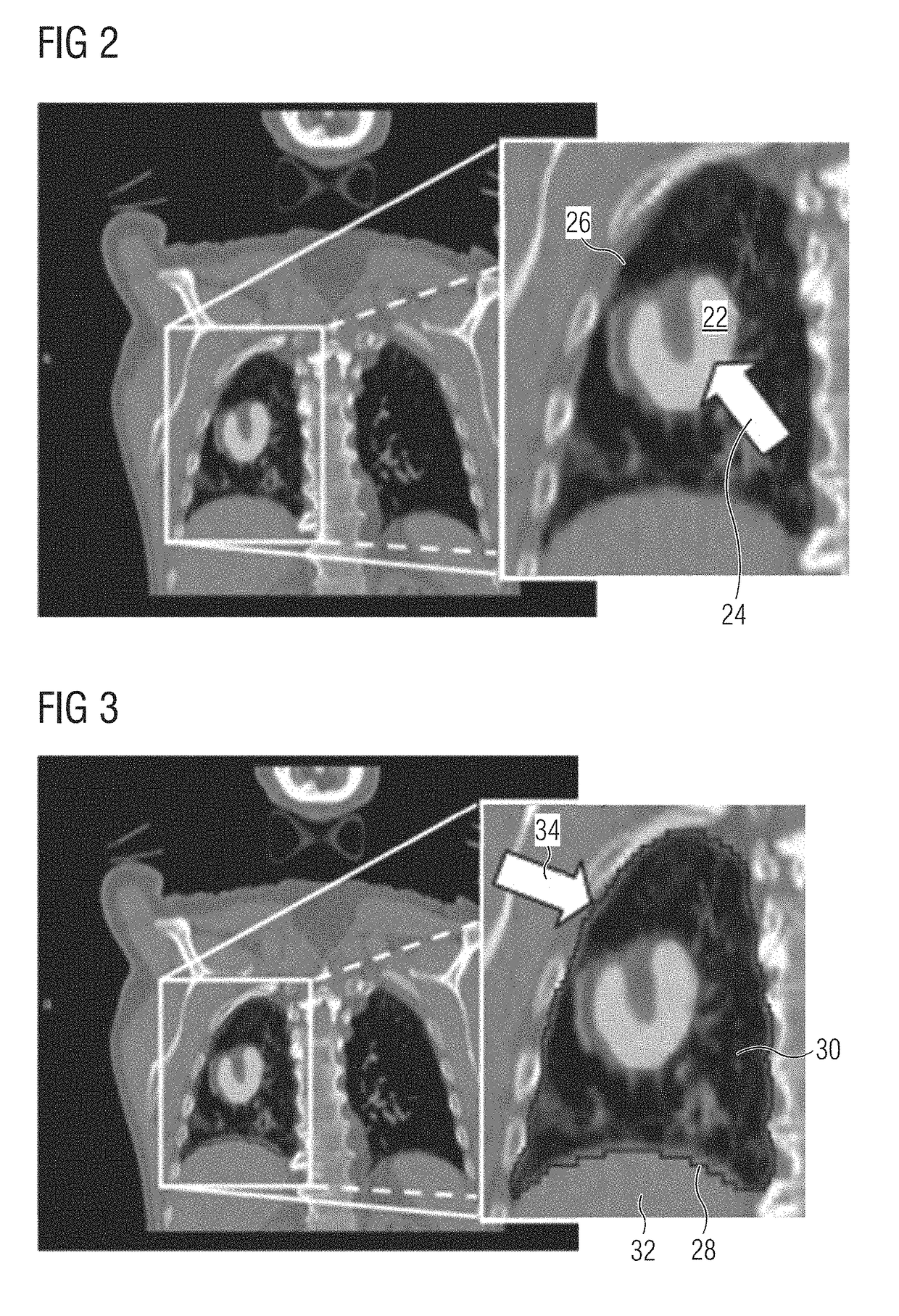 Automatic background region selection for lesion delineation in medical images