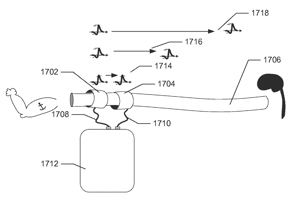 Neural Monitoring Methods and Systems for Treating Pharyngeal Disorders