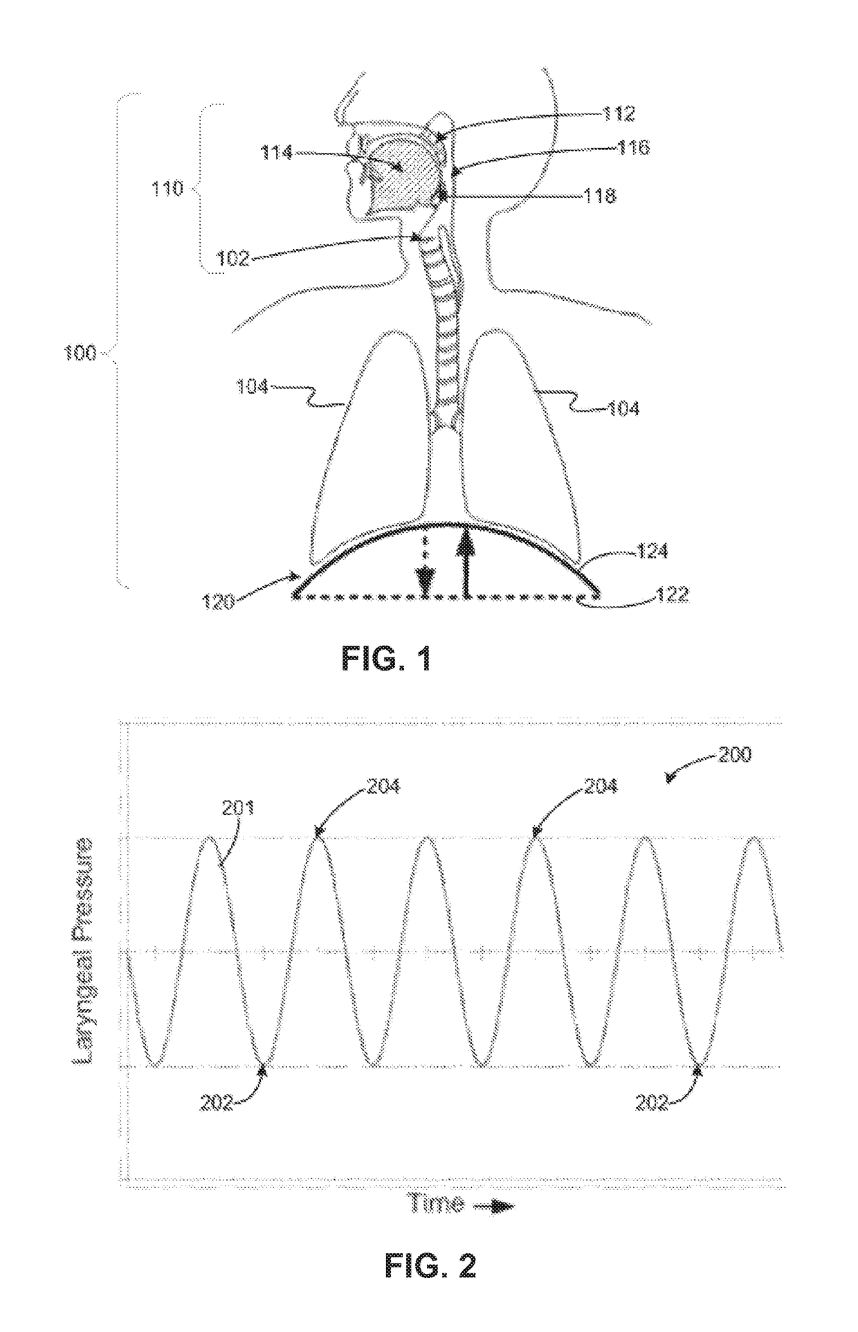 Neural Monitoring Methods and Systems for Treating Pharyngeal Disorders