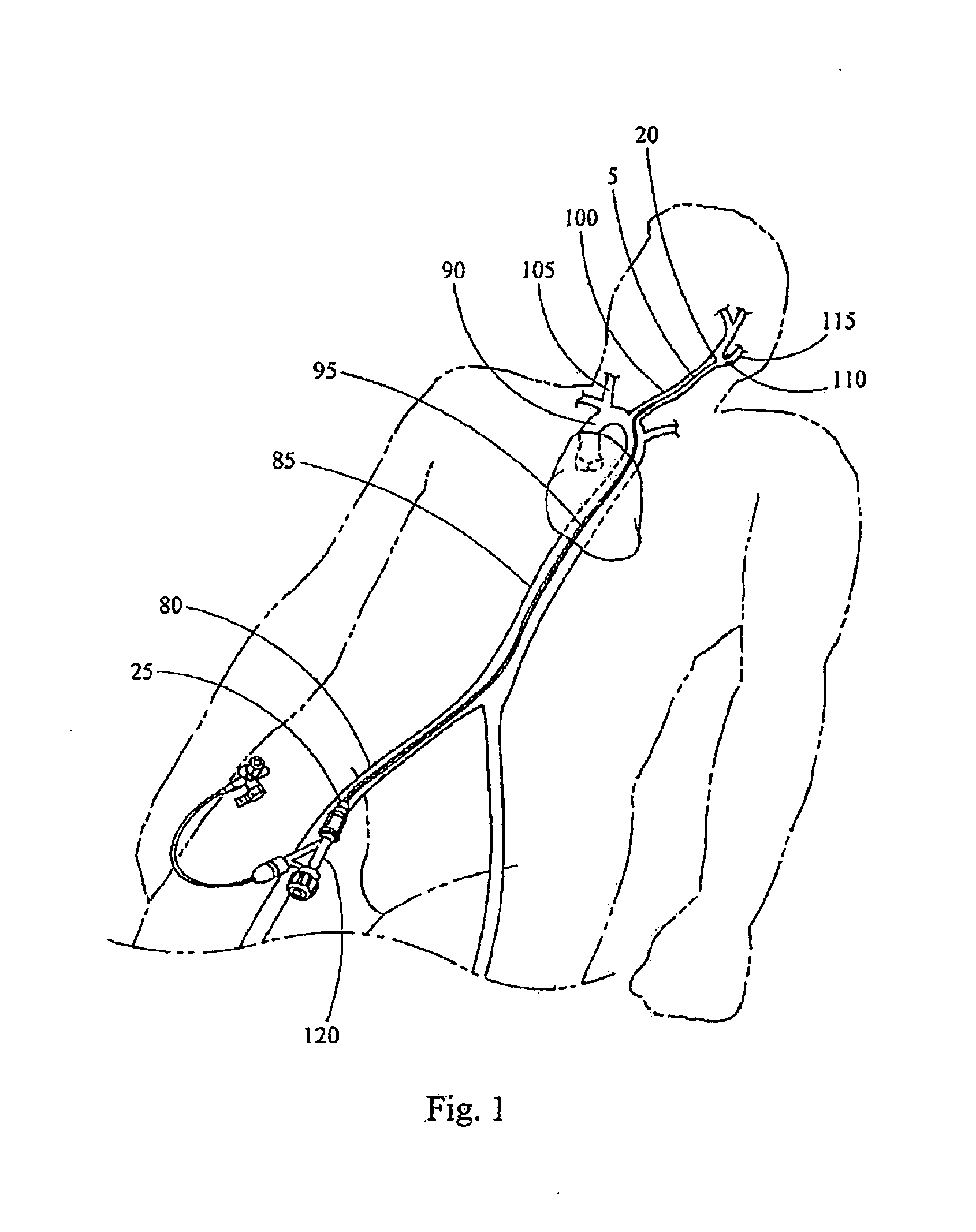 Delivery system for endoluminal devices