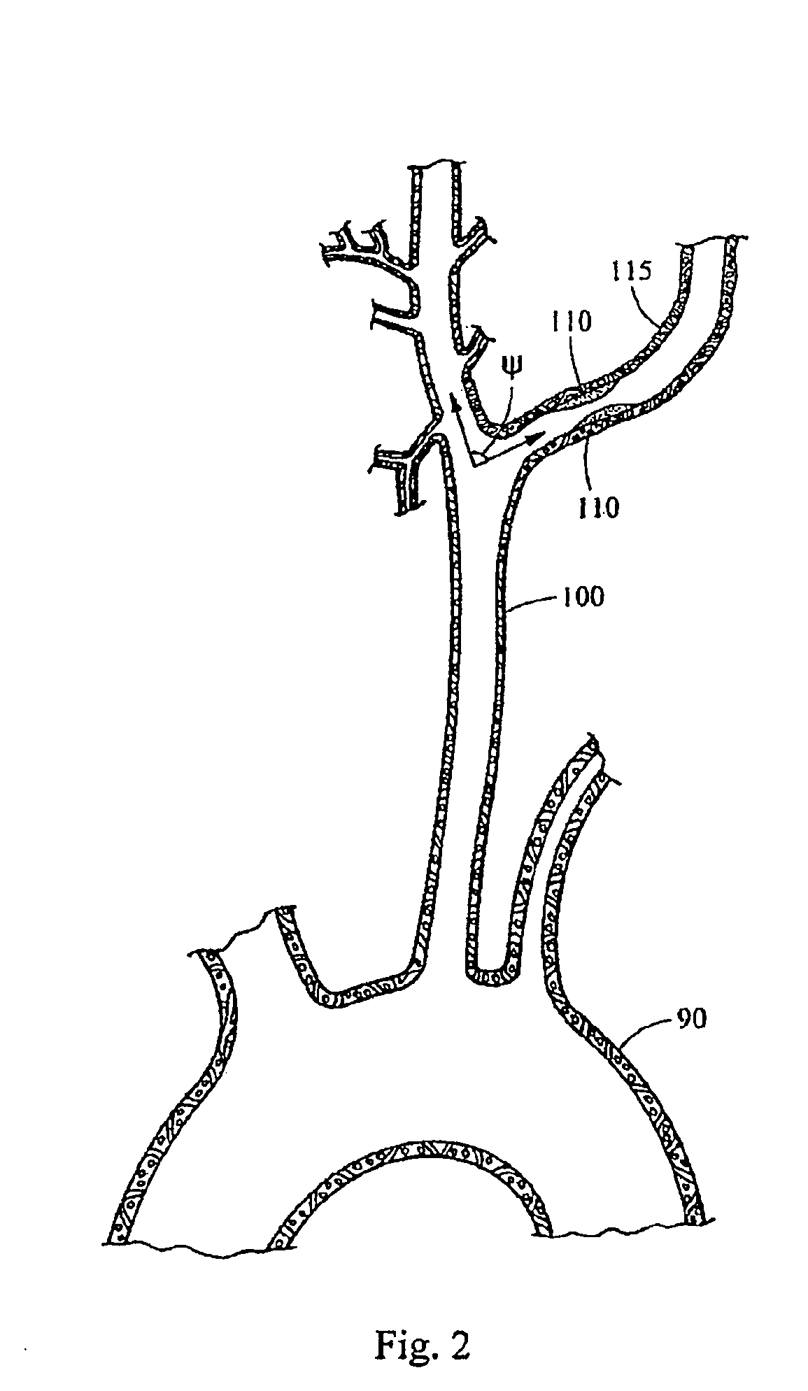 Delivery system for endoluminal devices