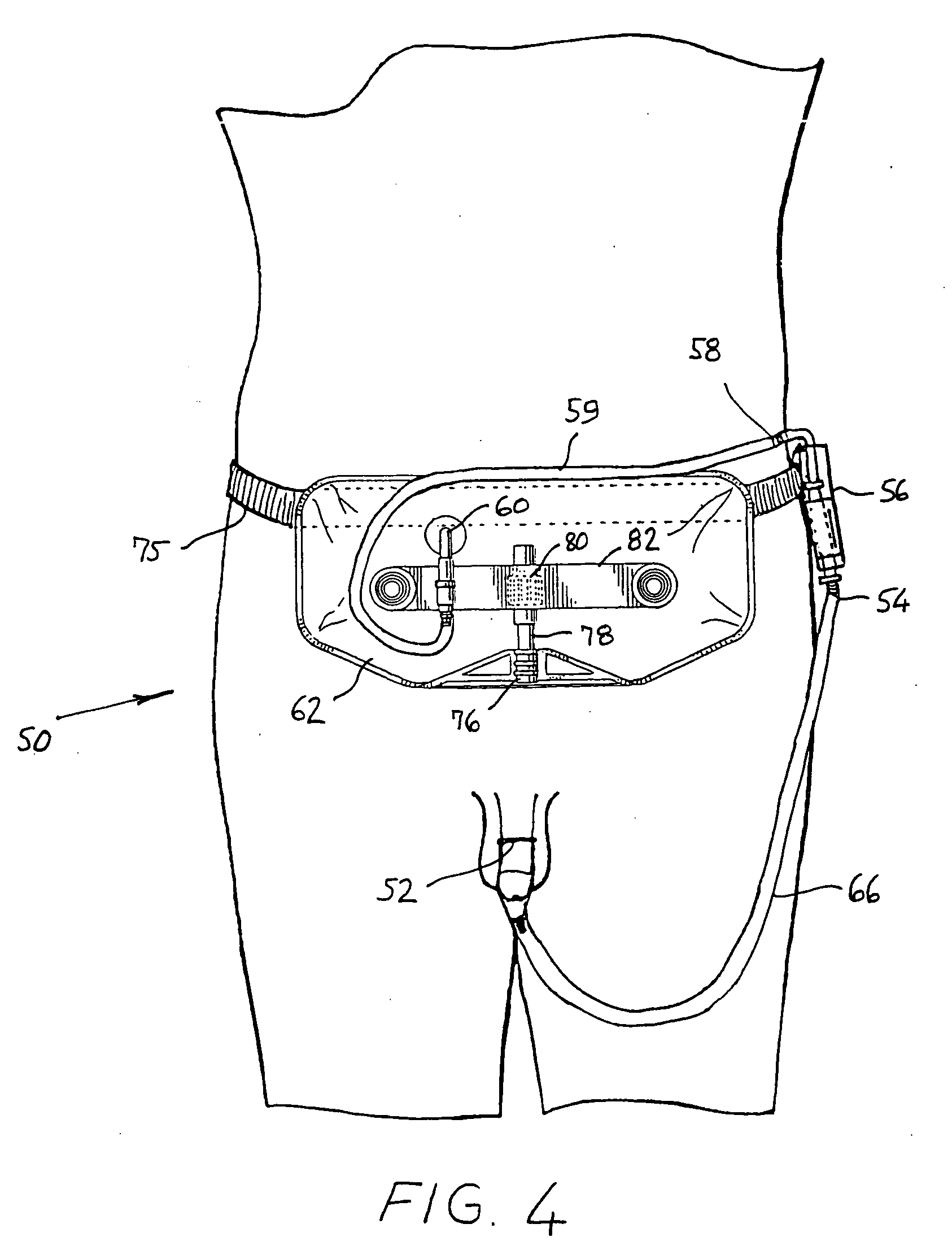 Urine pump for condom catheters and method for using