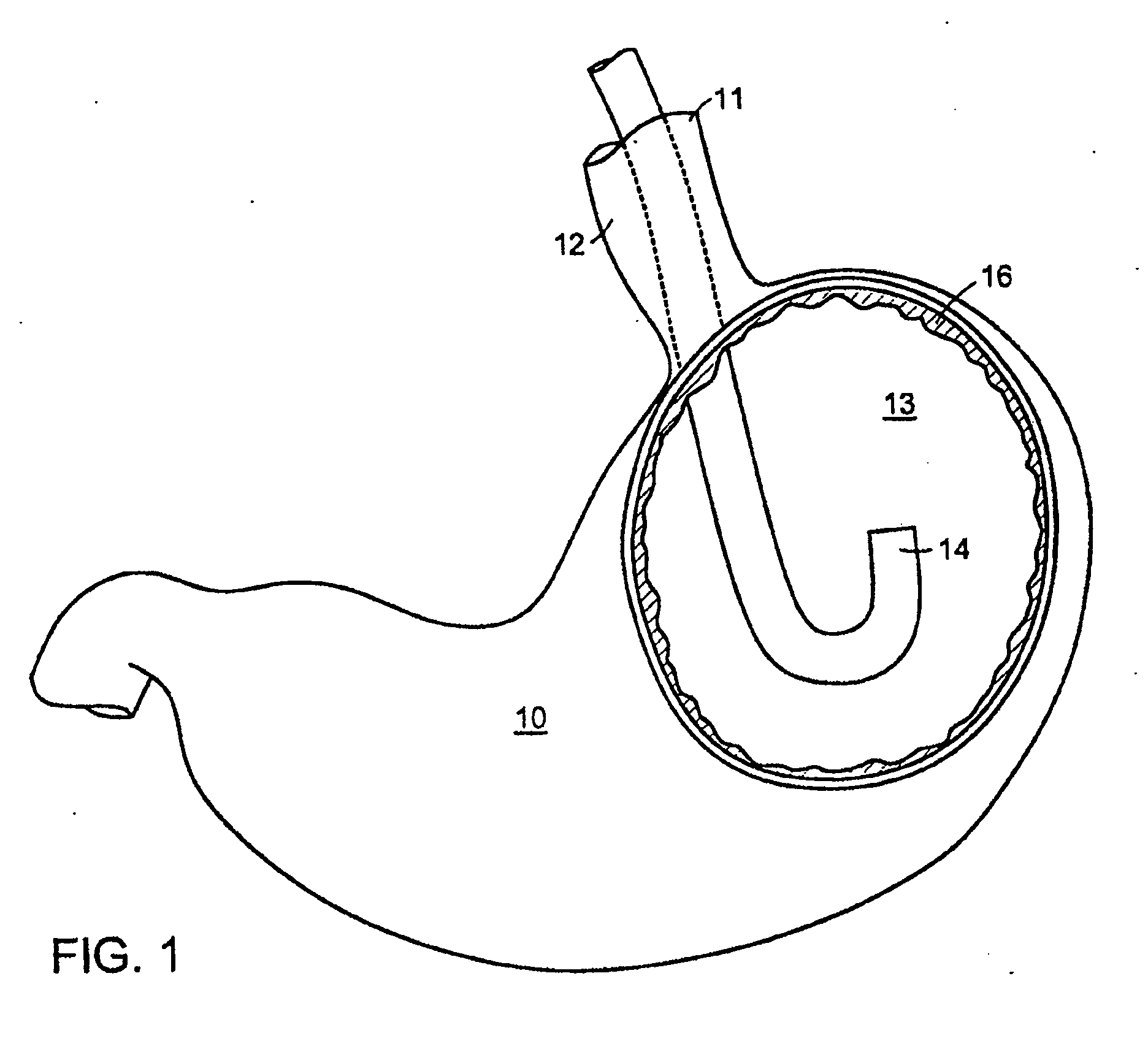 Methods and Devices for Tissue Reconfiguration