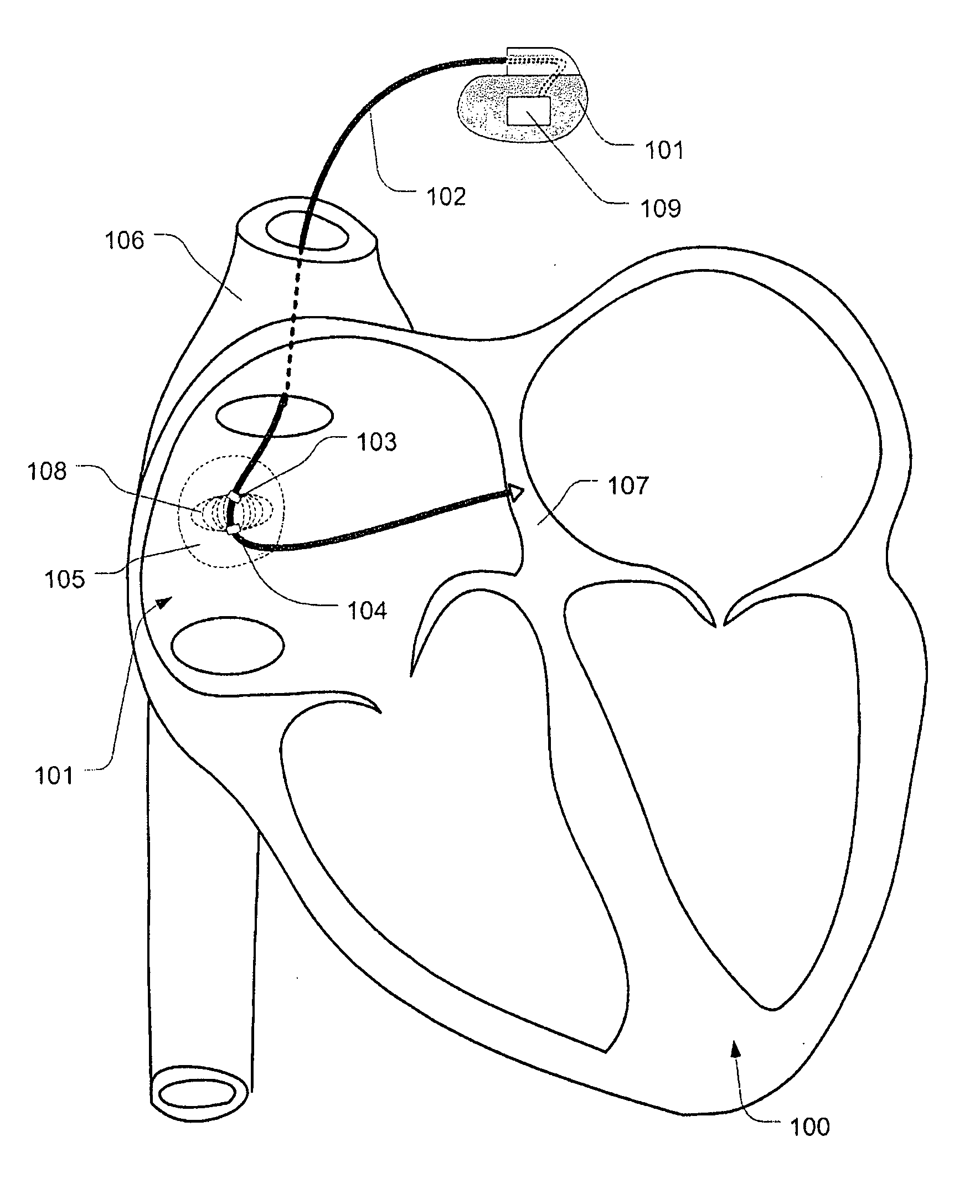 Heart rate reduction method and system