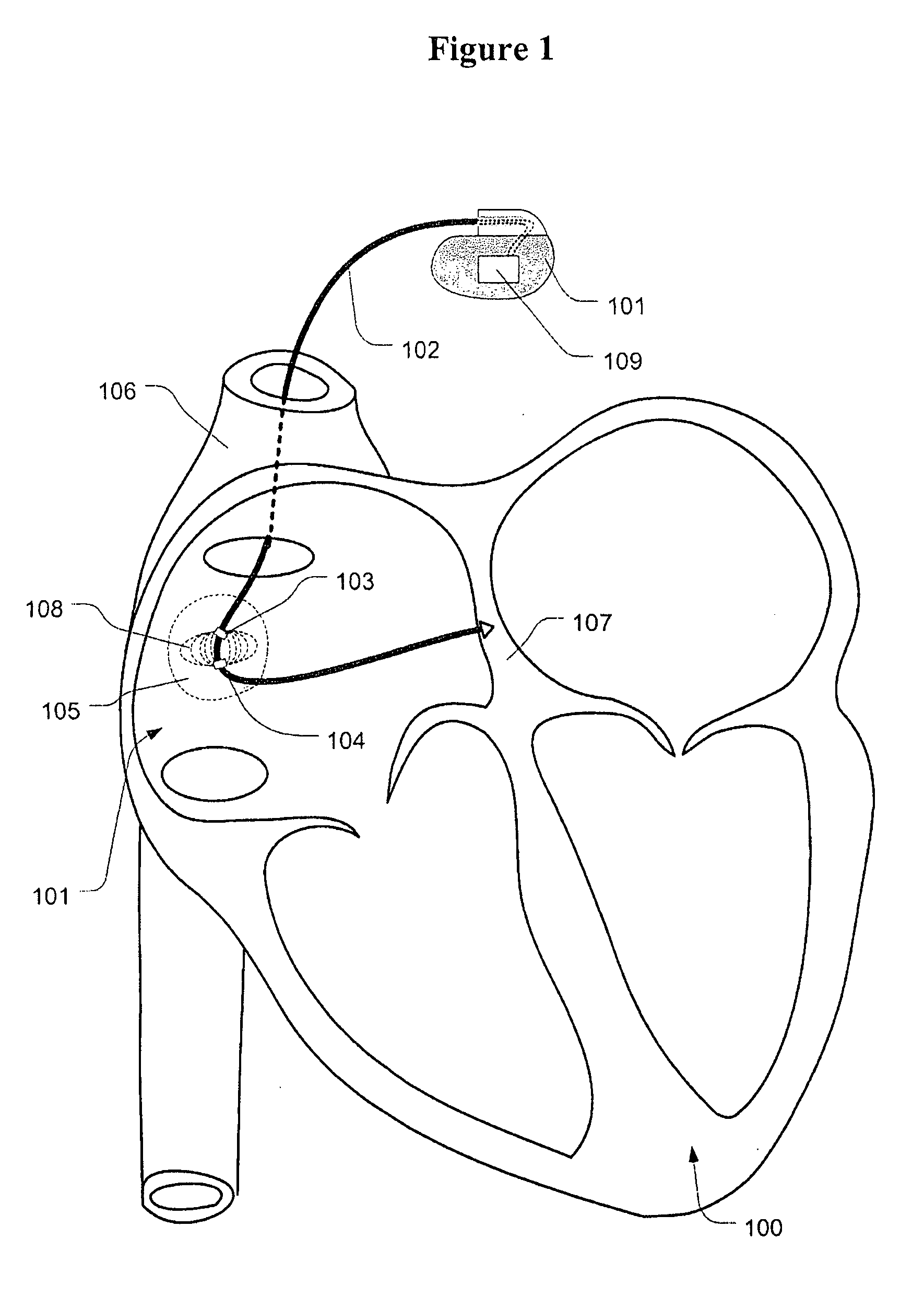 Heart rate reduction method and system