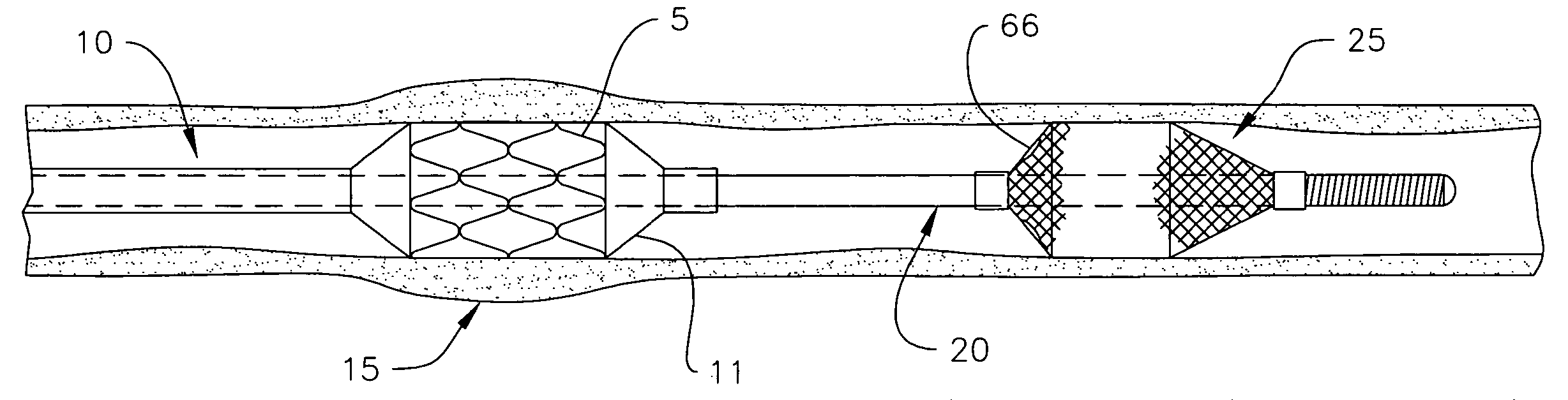 Steerable distal protection guidewire and methods of use