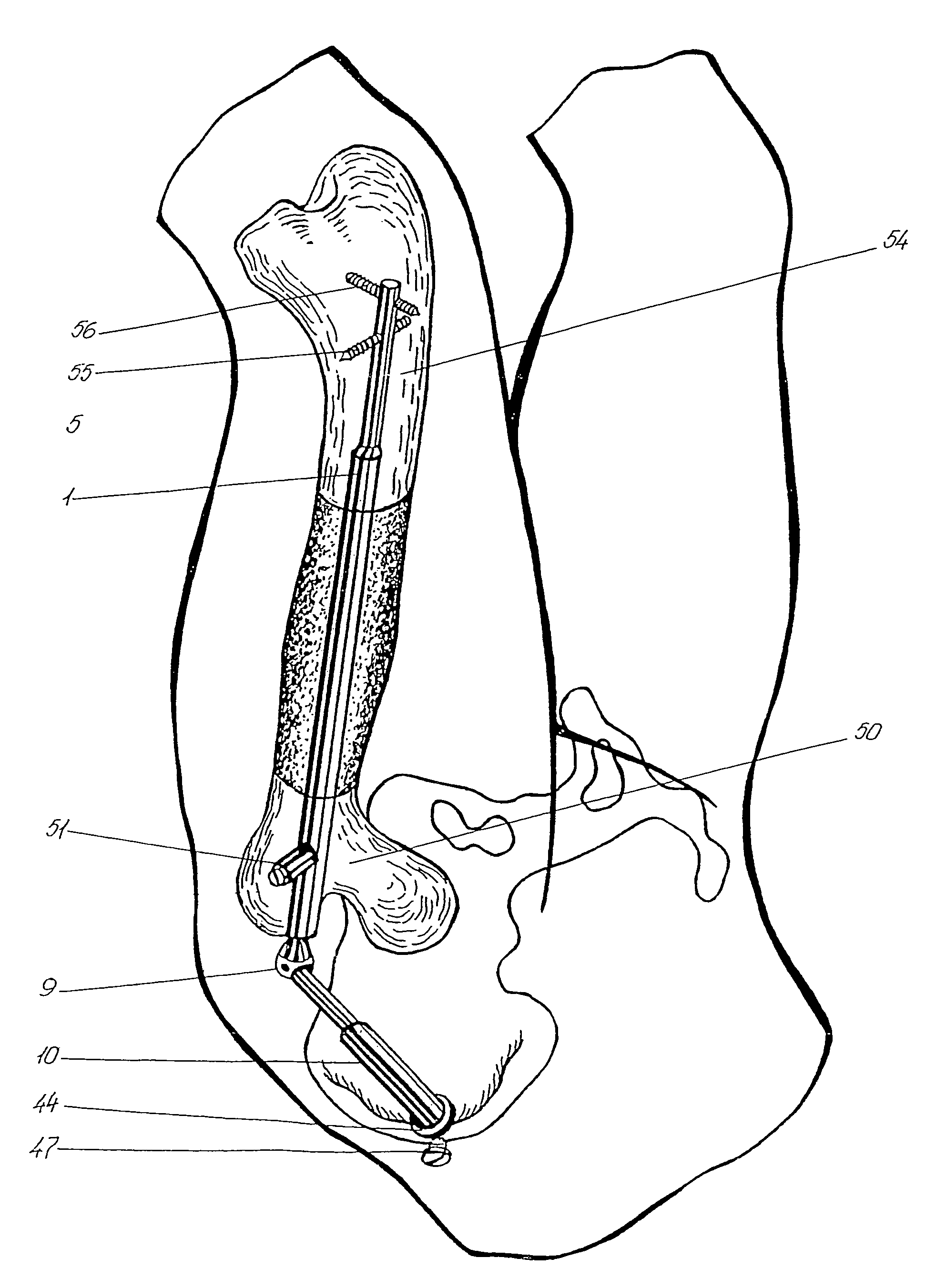 Bliskunov device for elongating long bones