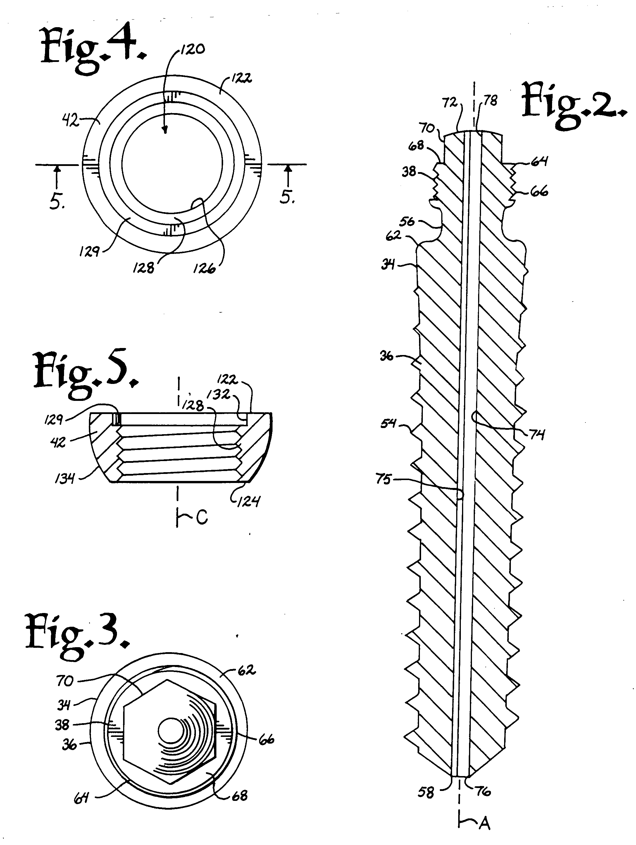 Helical reverse angle guide and advancement structure with break-off extensions