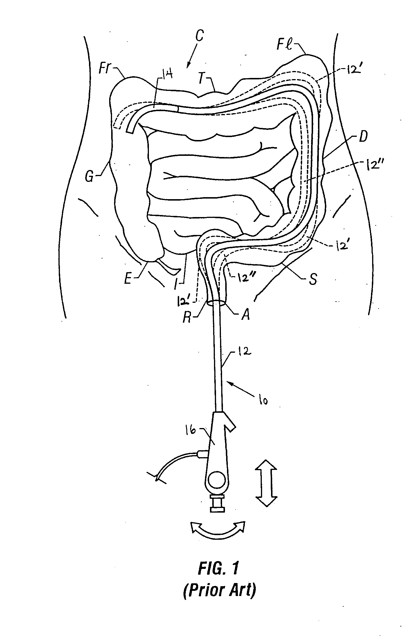 Method and apparatus having an elongate guide and controllable portion