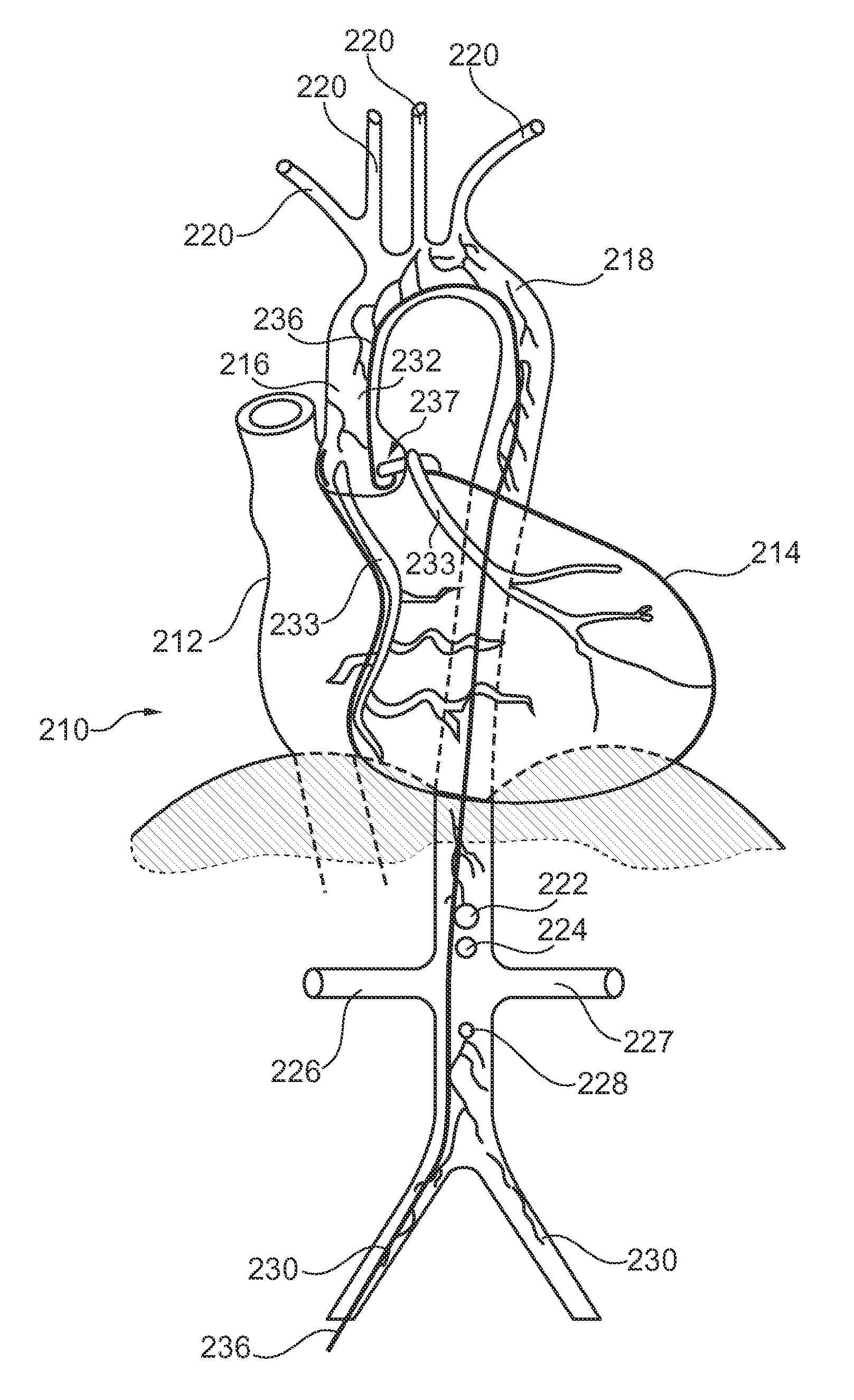 Medical imaging device for providing an image representation supporting the accurate positioning of an invention device in vessel intervention procedures
