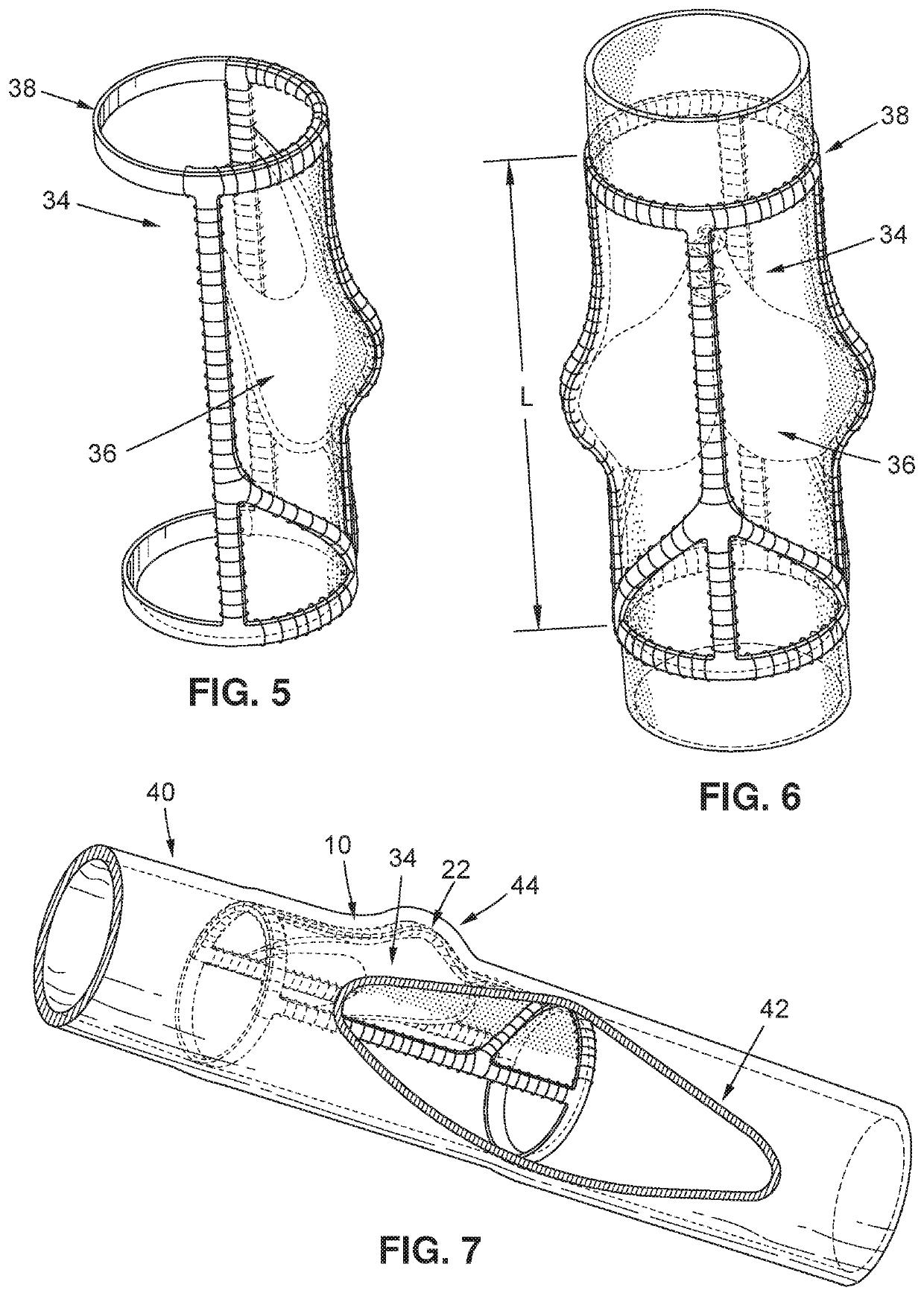 Implantable vein frame