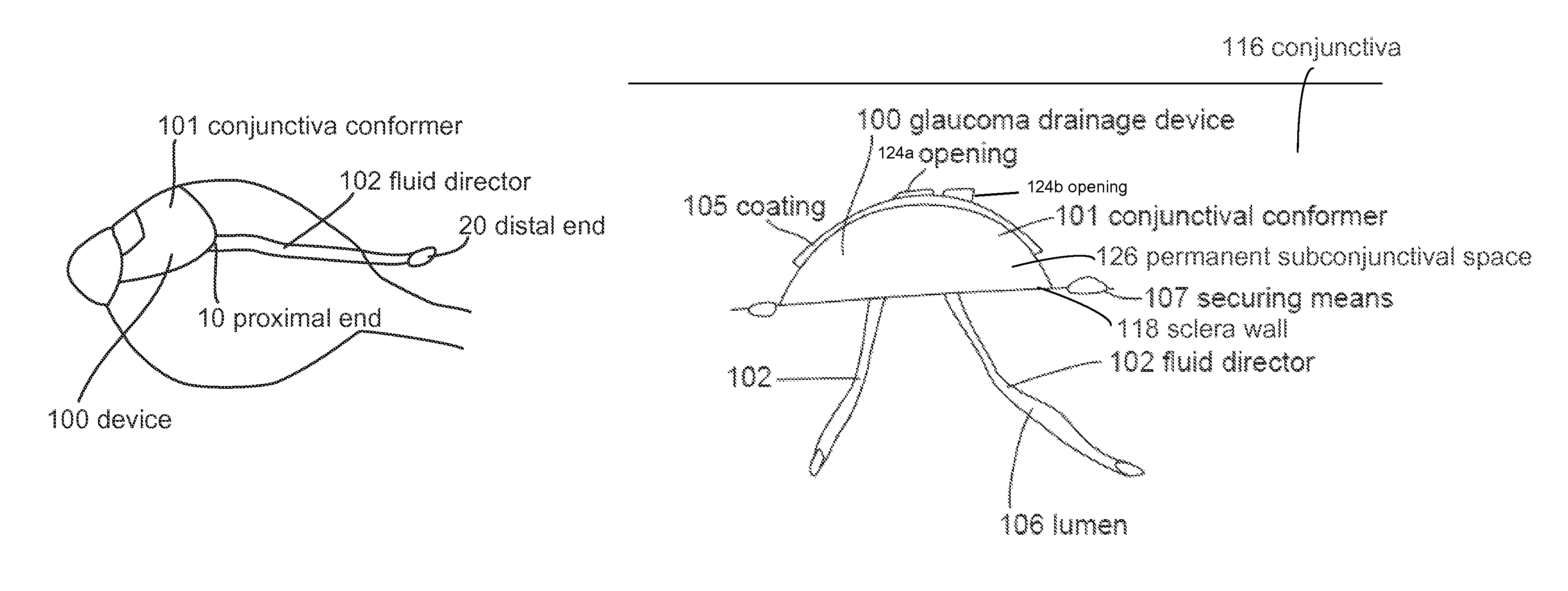 Subconjunctival conformer device and uses thereof