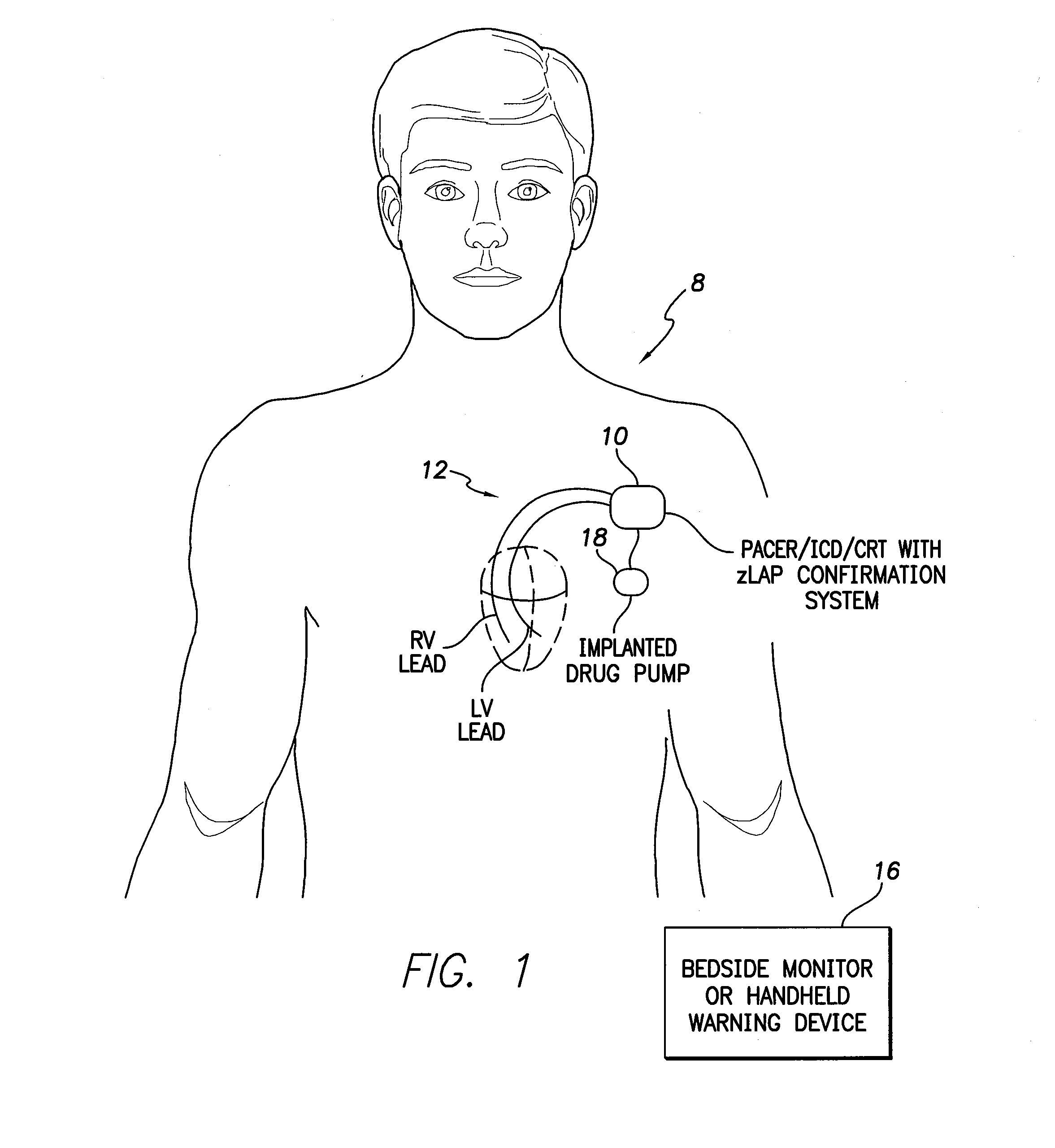 Systems and methods for corroborating impedance-based left atrial pressure (LAP) estimates for use by an implantable medical device