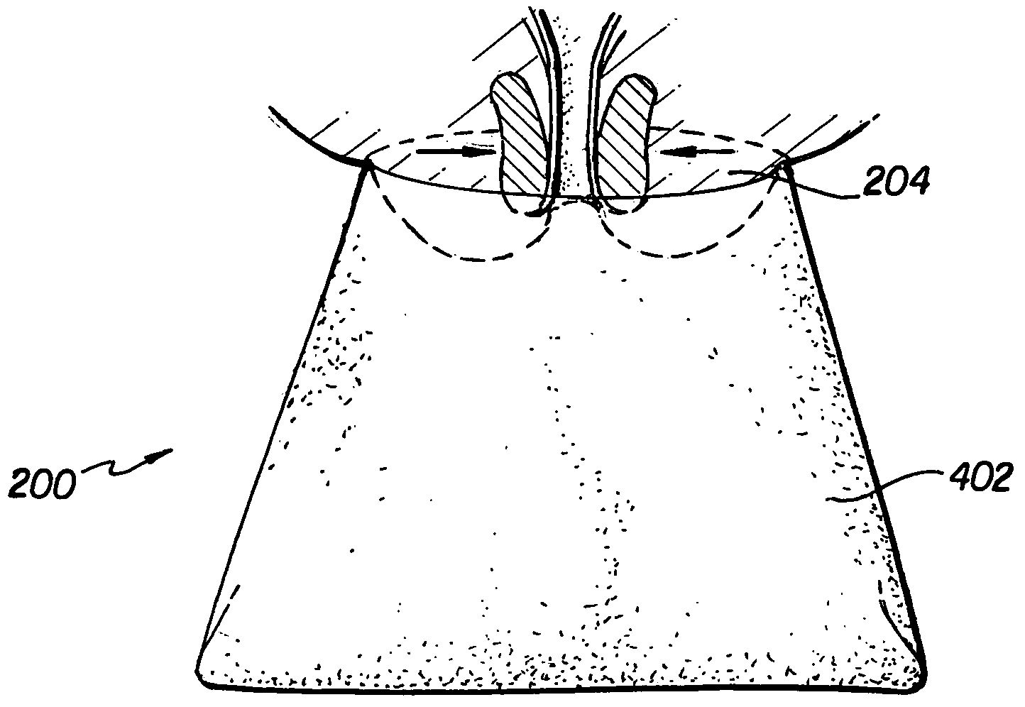 Inhibition action incontinence device and method