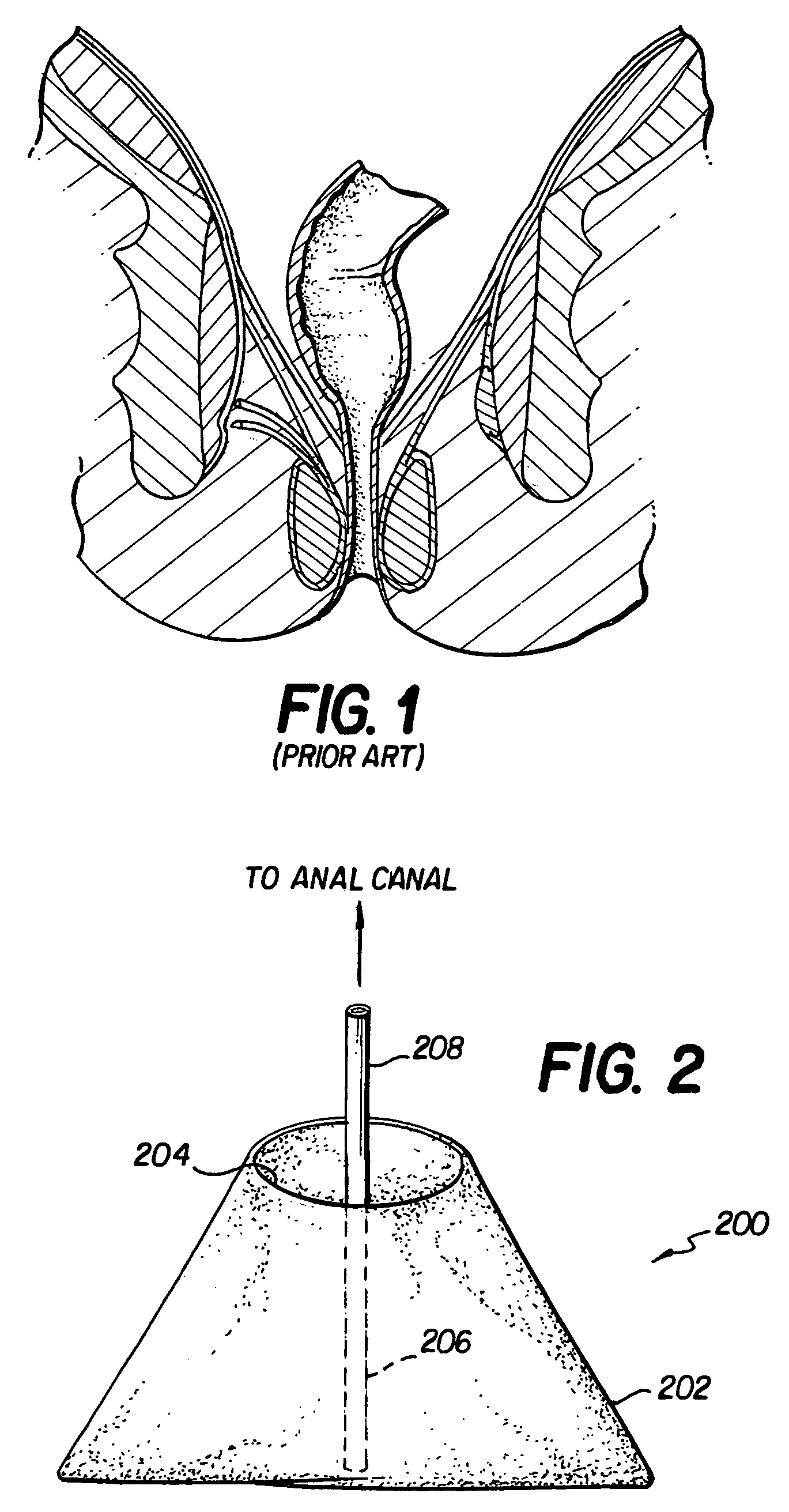 Inhibition action incontinence device and method