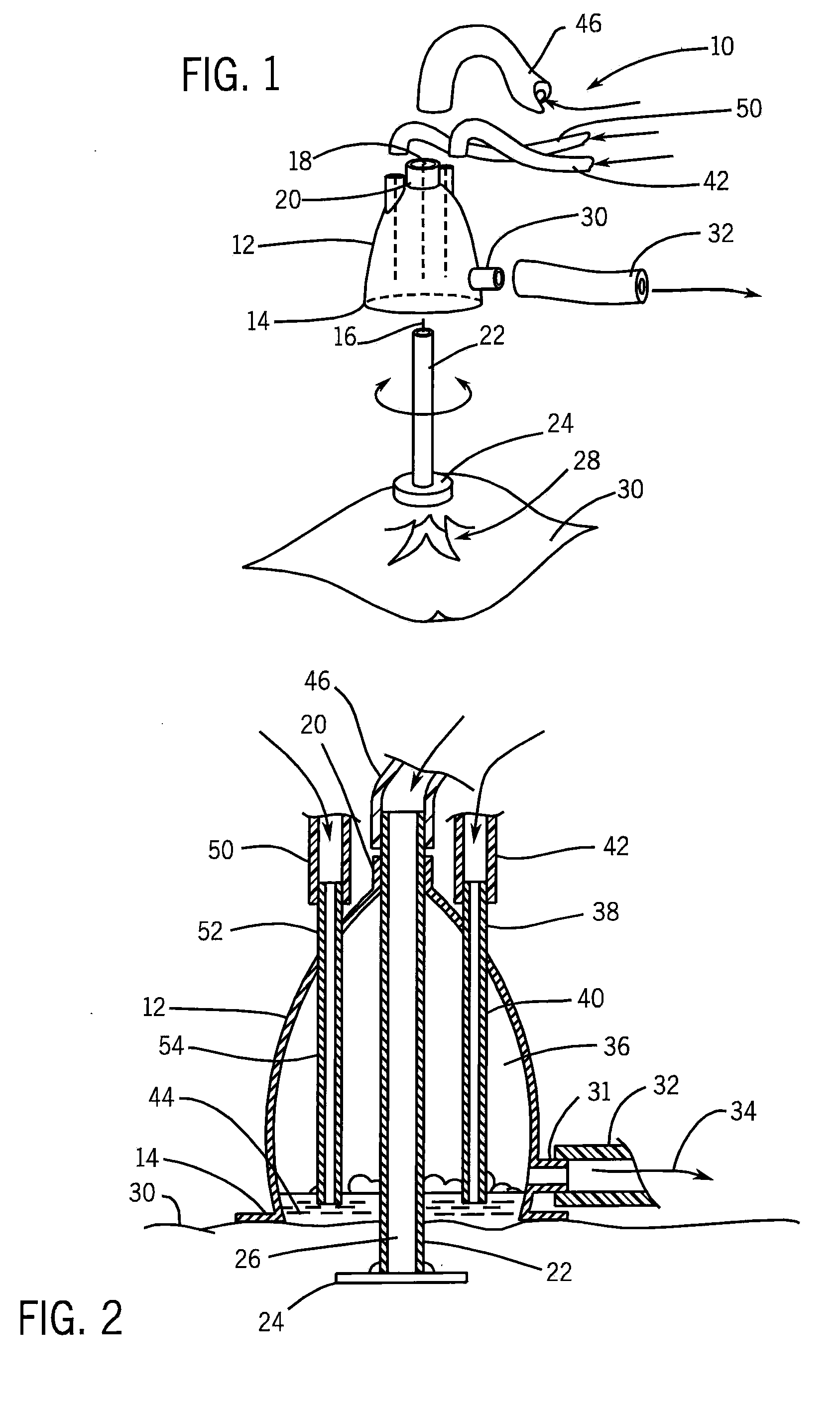 Device for Treatment of Venous Congestion