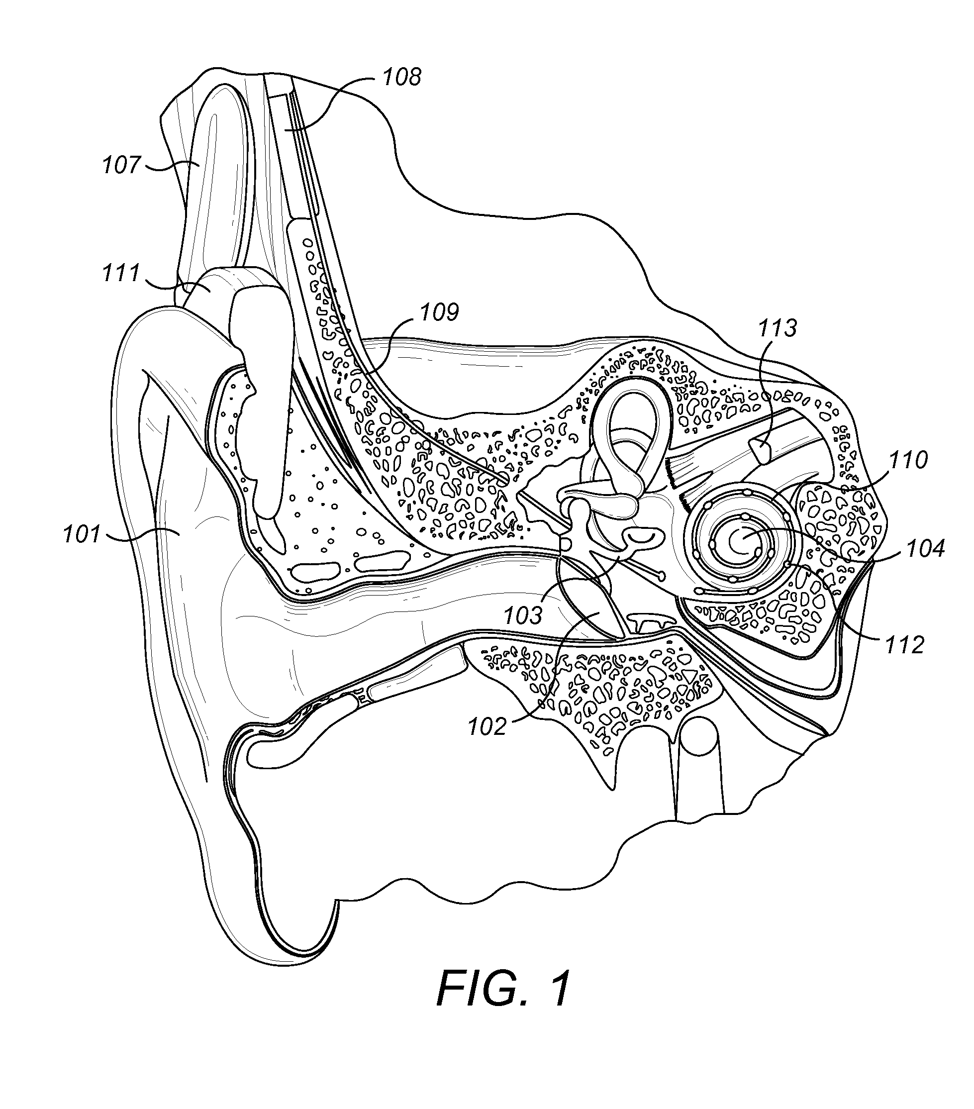 Cochlear Implant Electrode Insertion Support Device