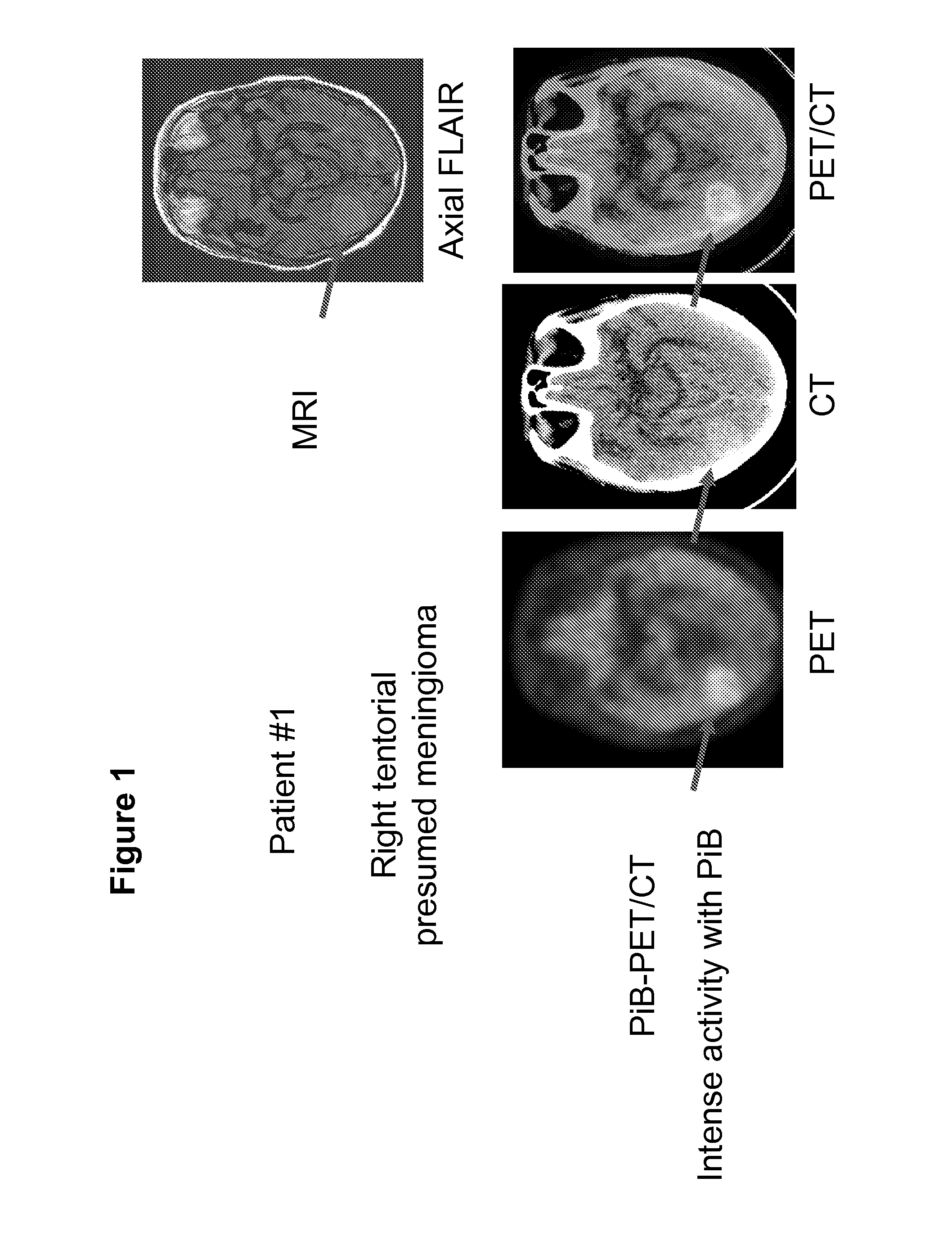 Imaging of meningiomas using phenylbenzothiazole, stilbene, or biphenylalkyne derivatives