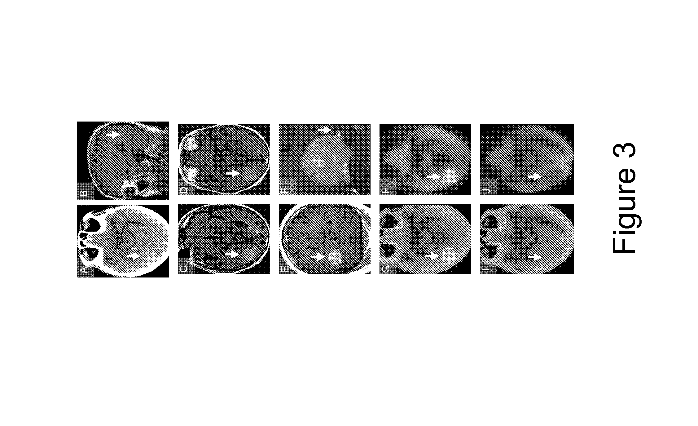 Imaging of meningiomas using phenylbenzothiazole, stilbene, or biphenylalkyne derivatives