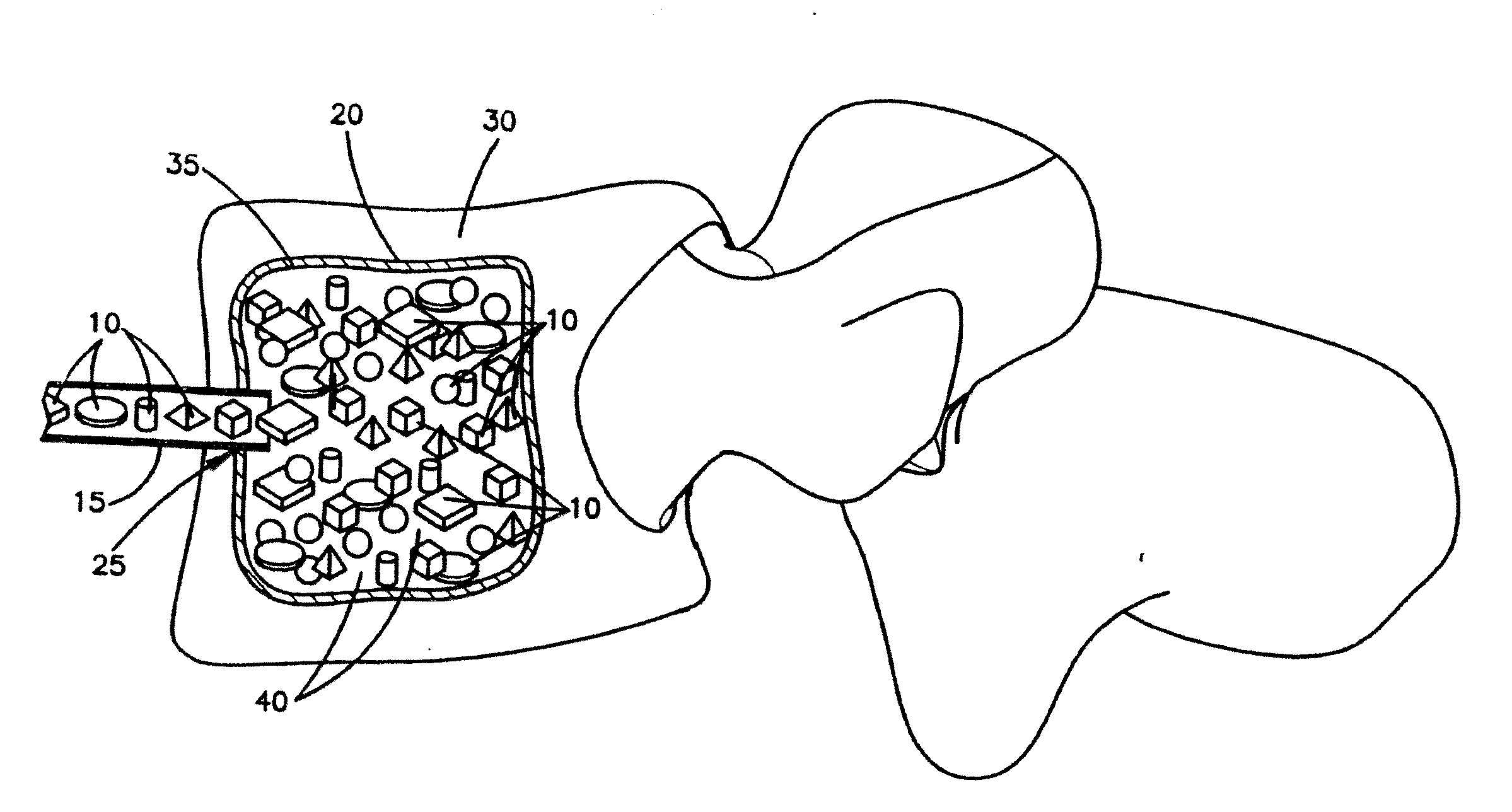 Demineralized cortical bone implants