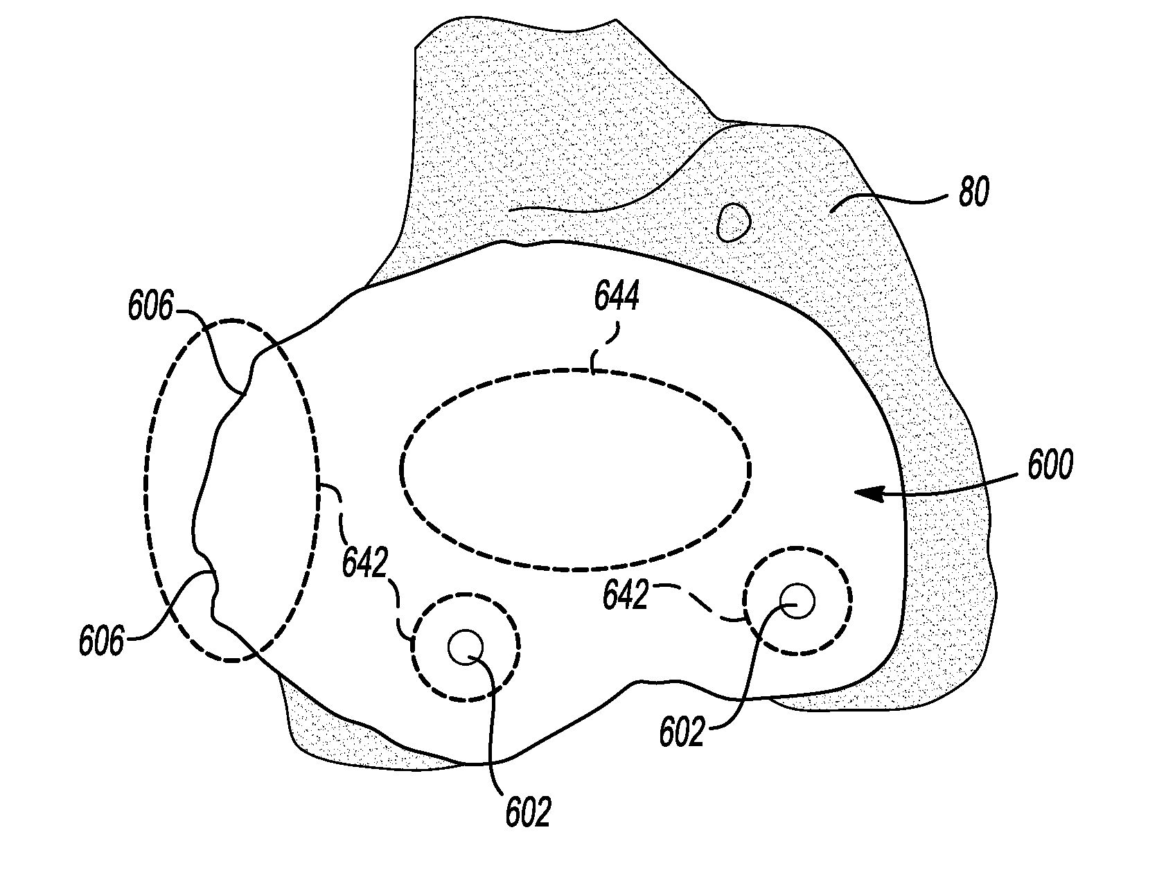 Patient-Specific Knee Alignment Guide And Associated Method
