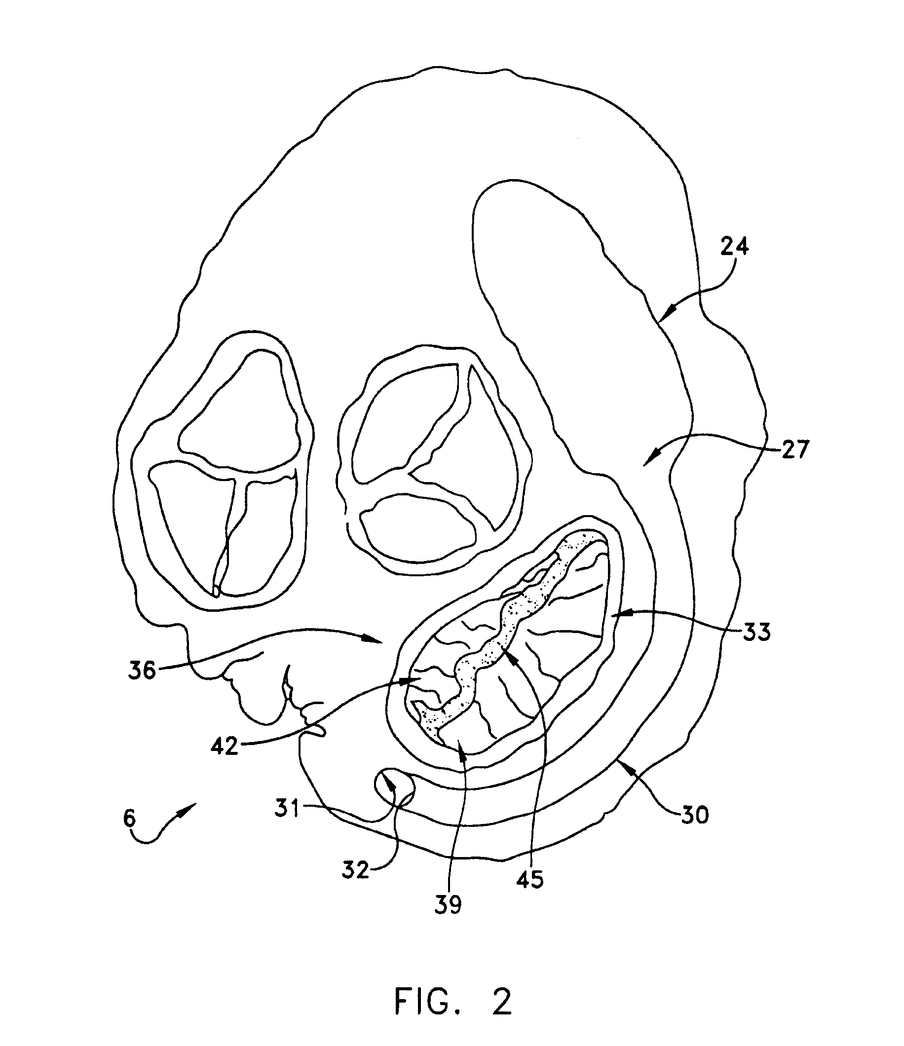 Method and apparatus for improving mitral valve function