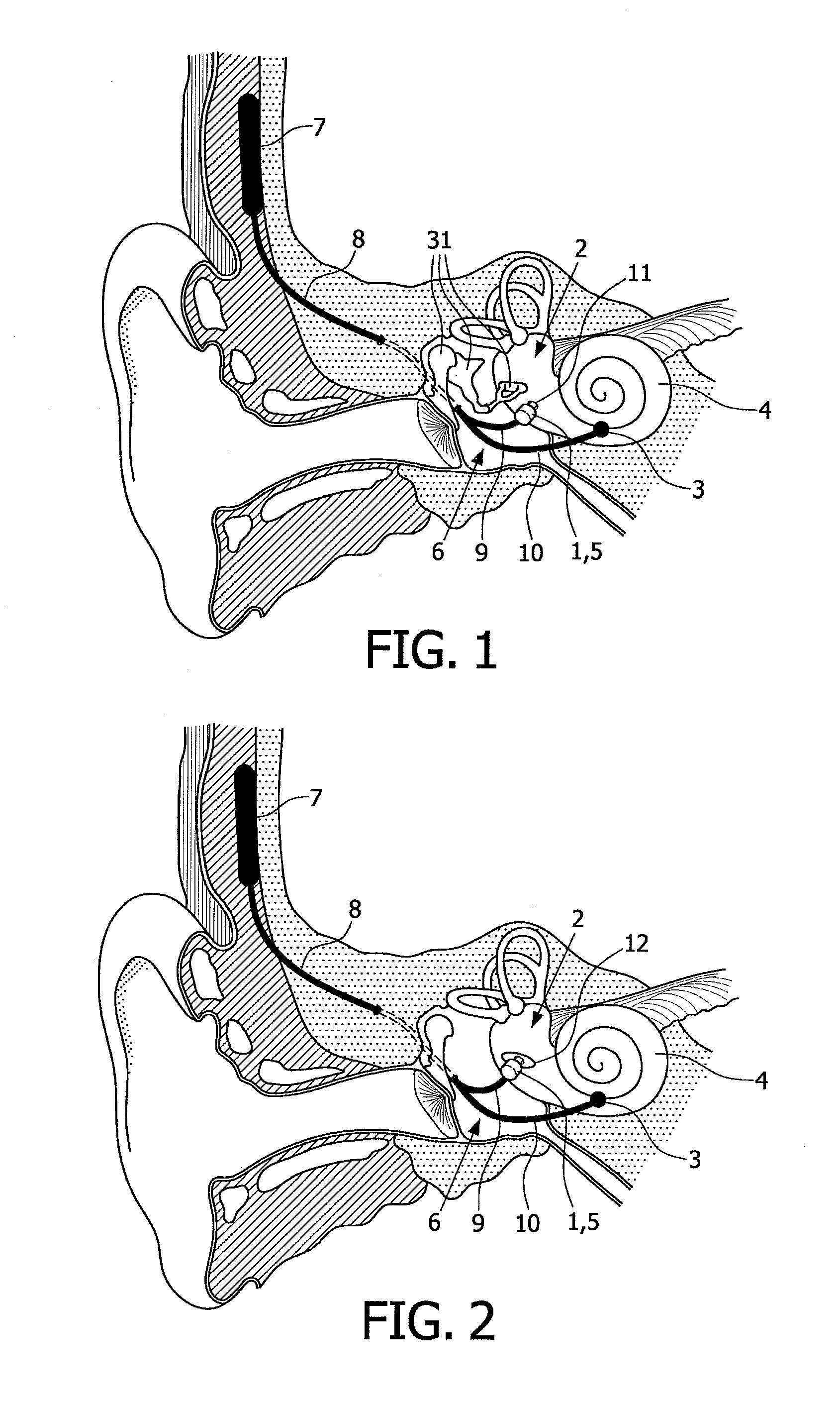 Device and method for improving hearing