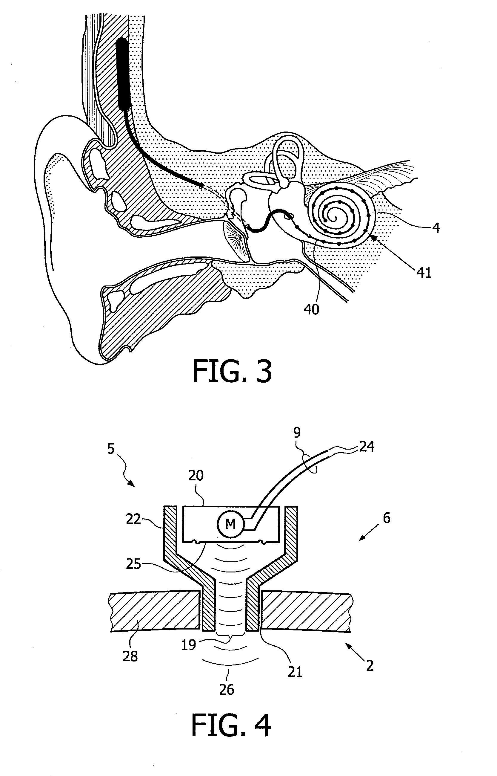 Device and method for improving hearing