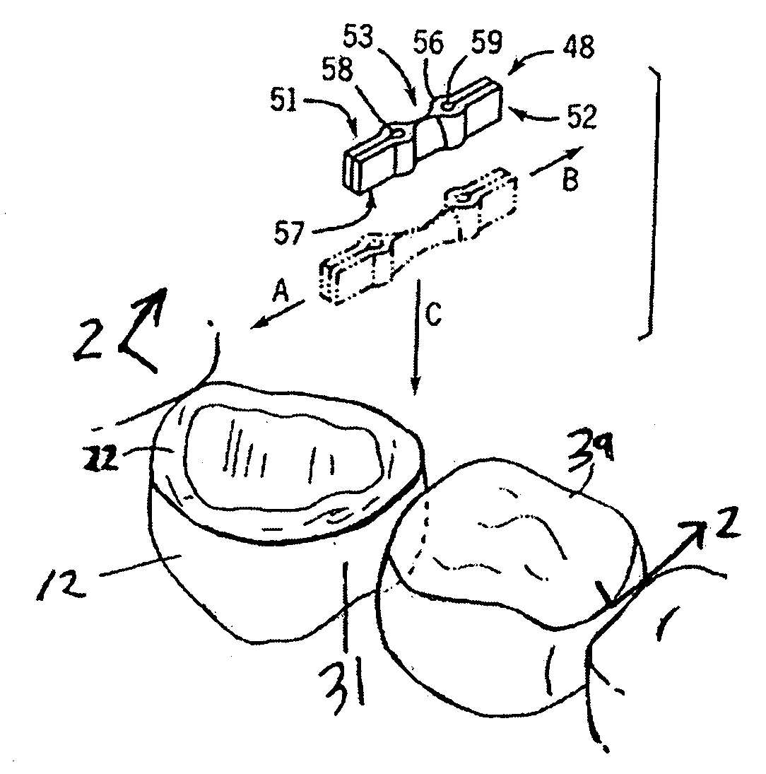 Methods and Devices for Fixed Dental Restoration