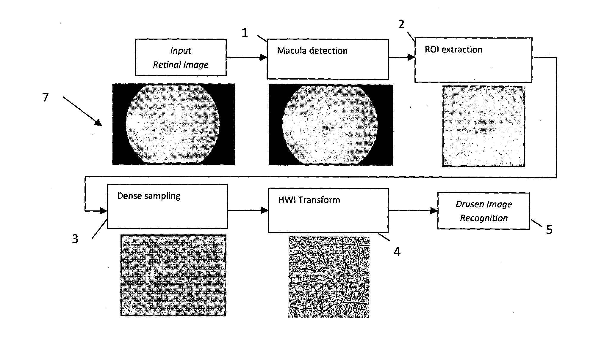 Drusen lesion image detection system