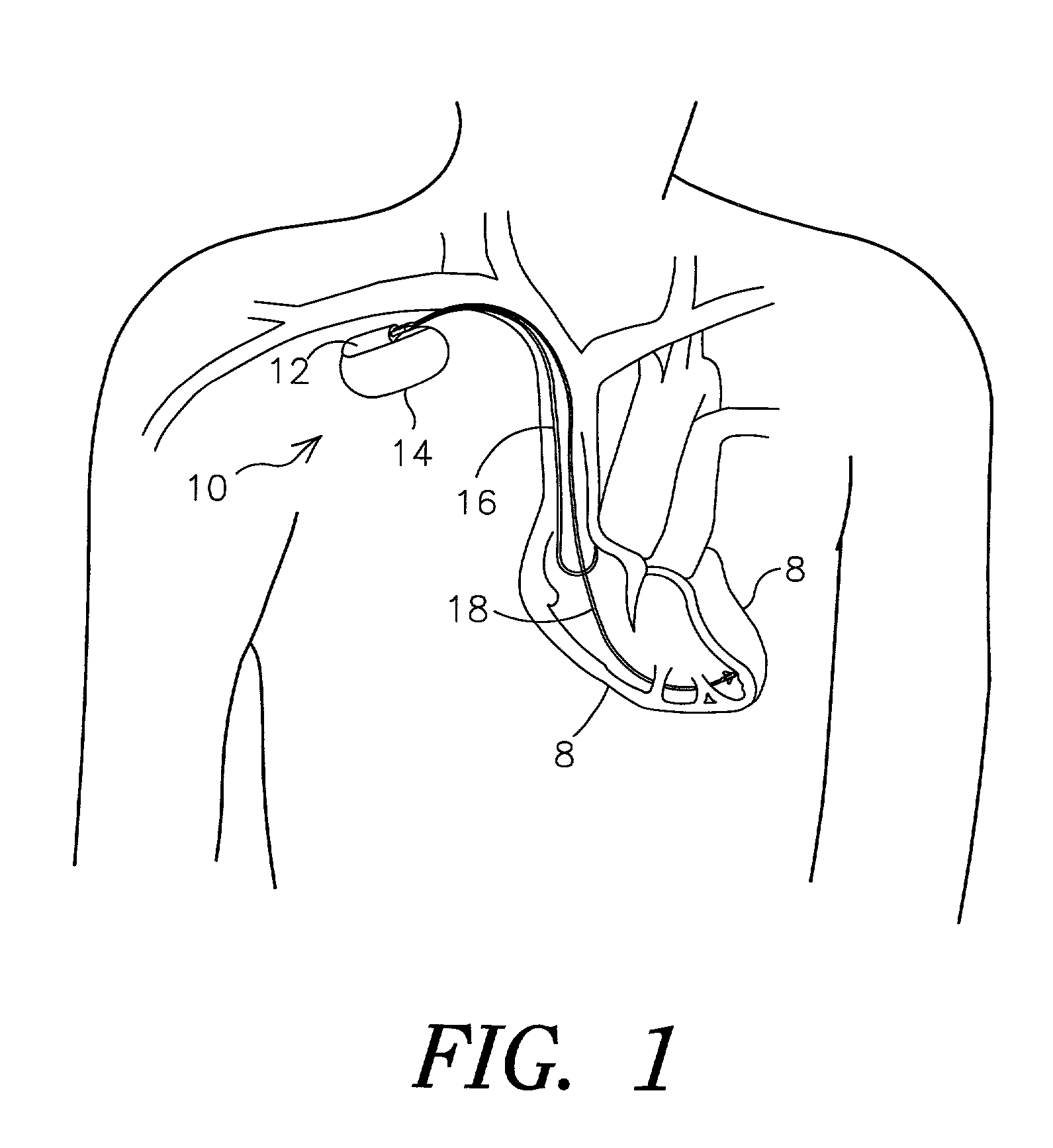 Diagnostic features in biatrial and biventricular pacing systems