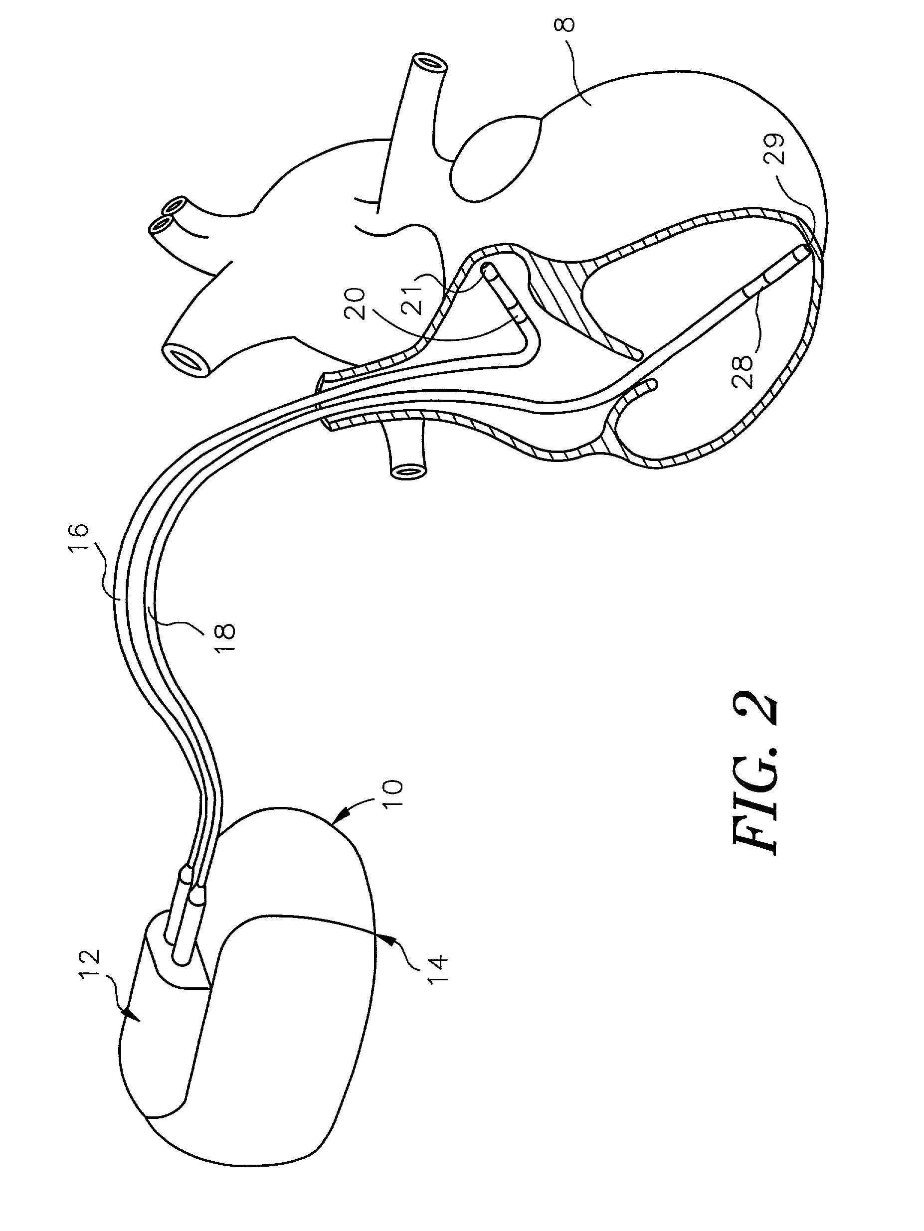 Diagnostic features in biatrial and biventricular pacing systems