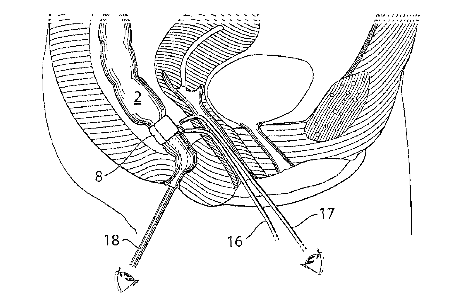 Vaginal operation method for the treatment of anal incontinence in women