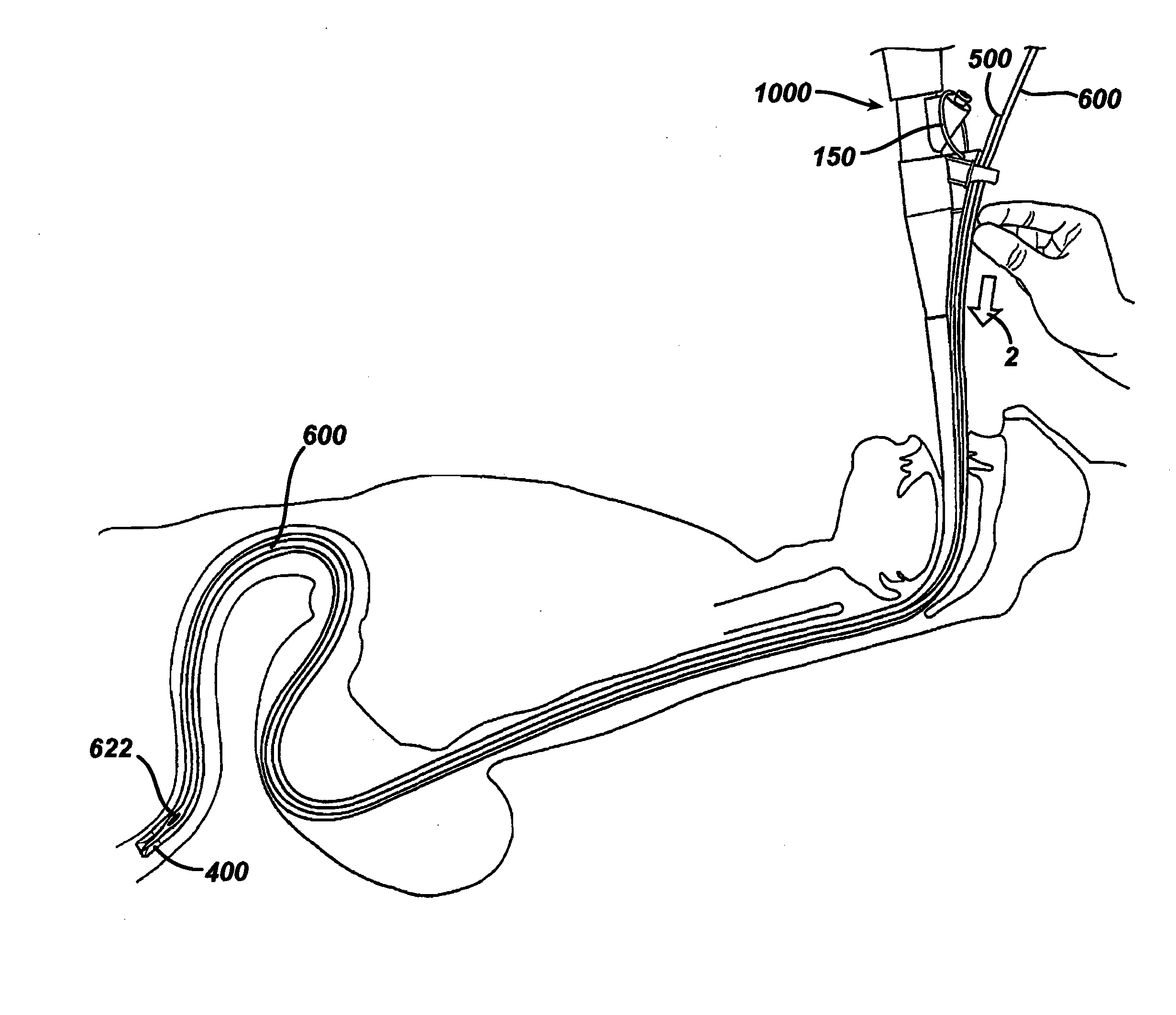 Method for deploying a medical device