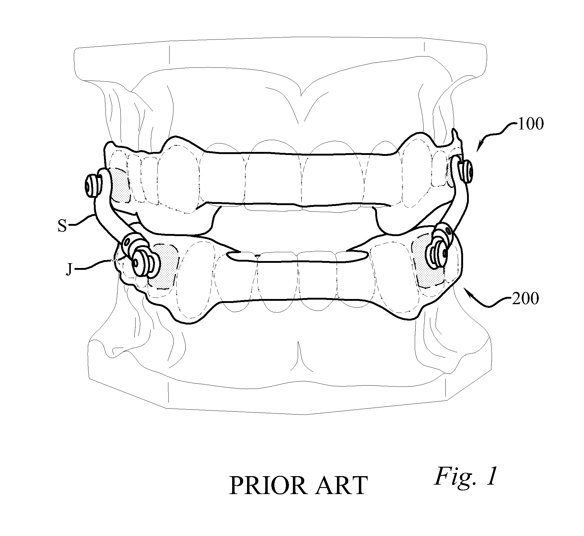 Anti-obstructive airway dental orthotic