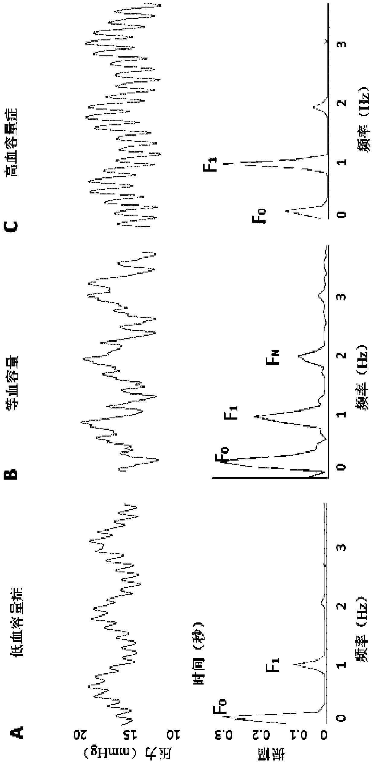 Hypovolemia/Hypervolaemia Detection Using Peripheral Intravenous Waveform Analysis (piva) and Its Applications