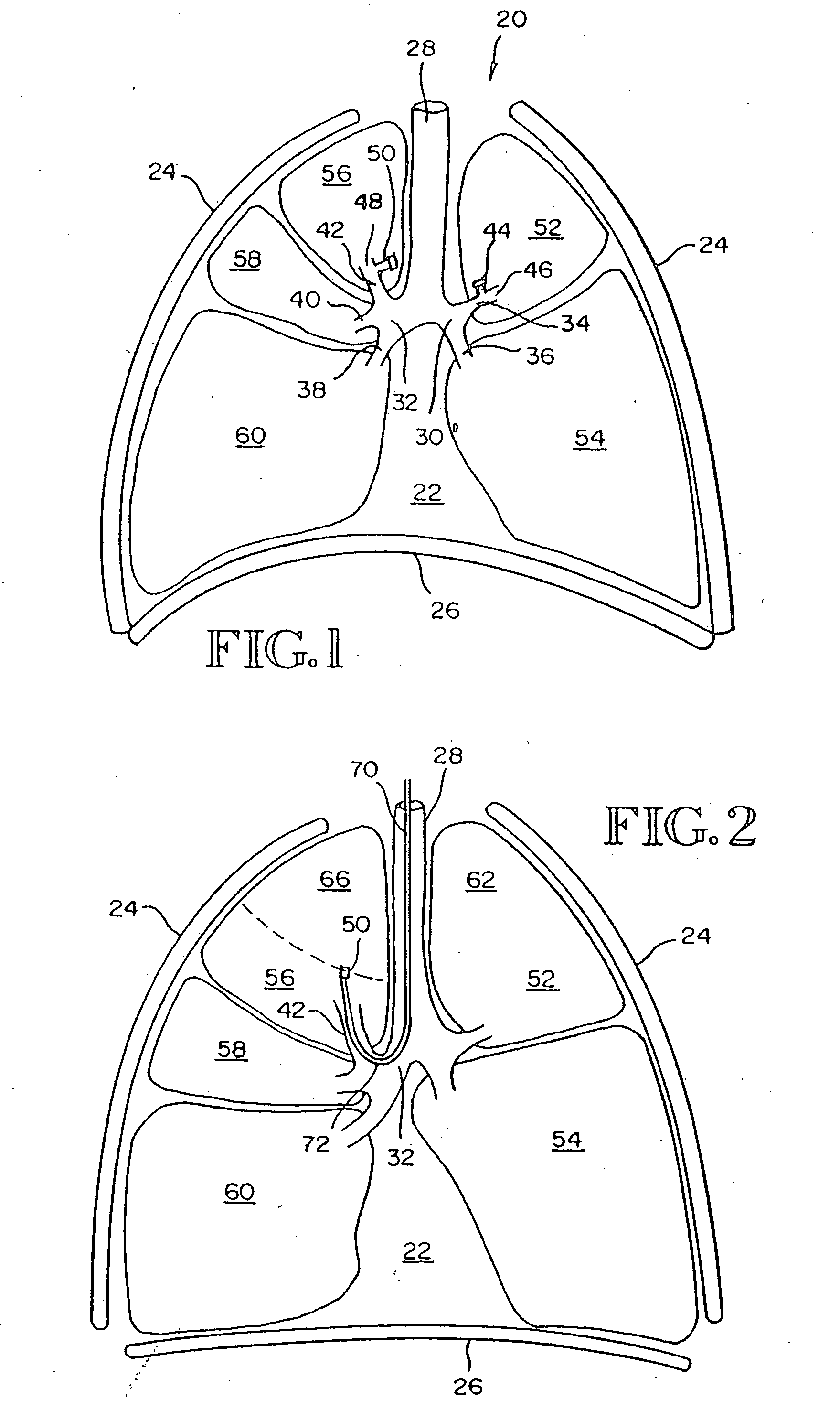 Intra-bronchial obstructing device that controls biological interaction with the patient