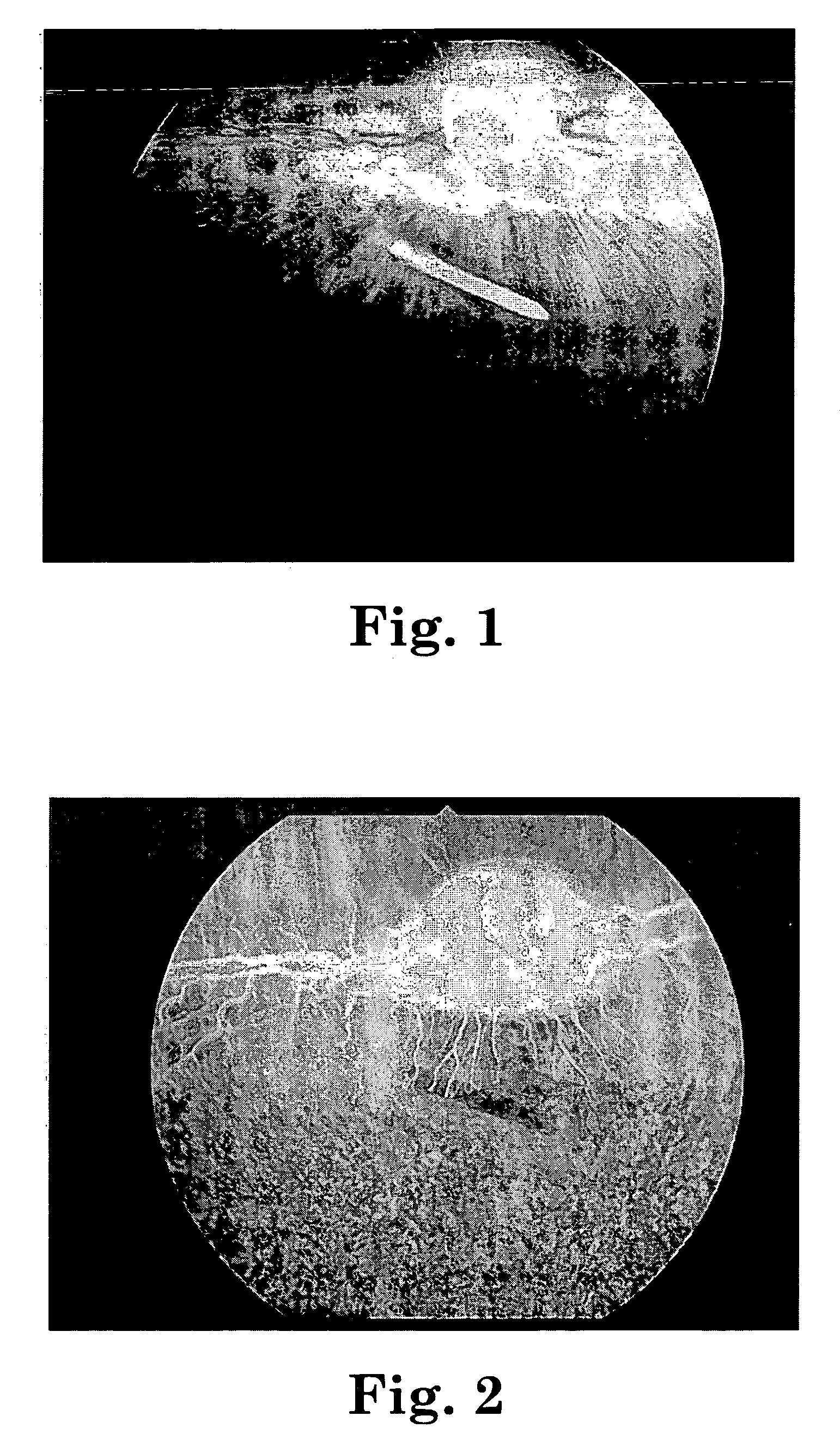 Sustained release implants and methods for subretinal delivery of bioactive agents to treat or prevent retinal disease