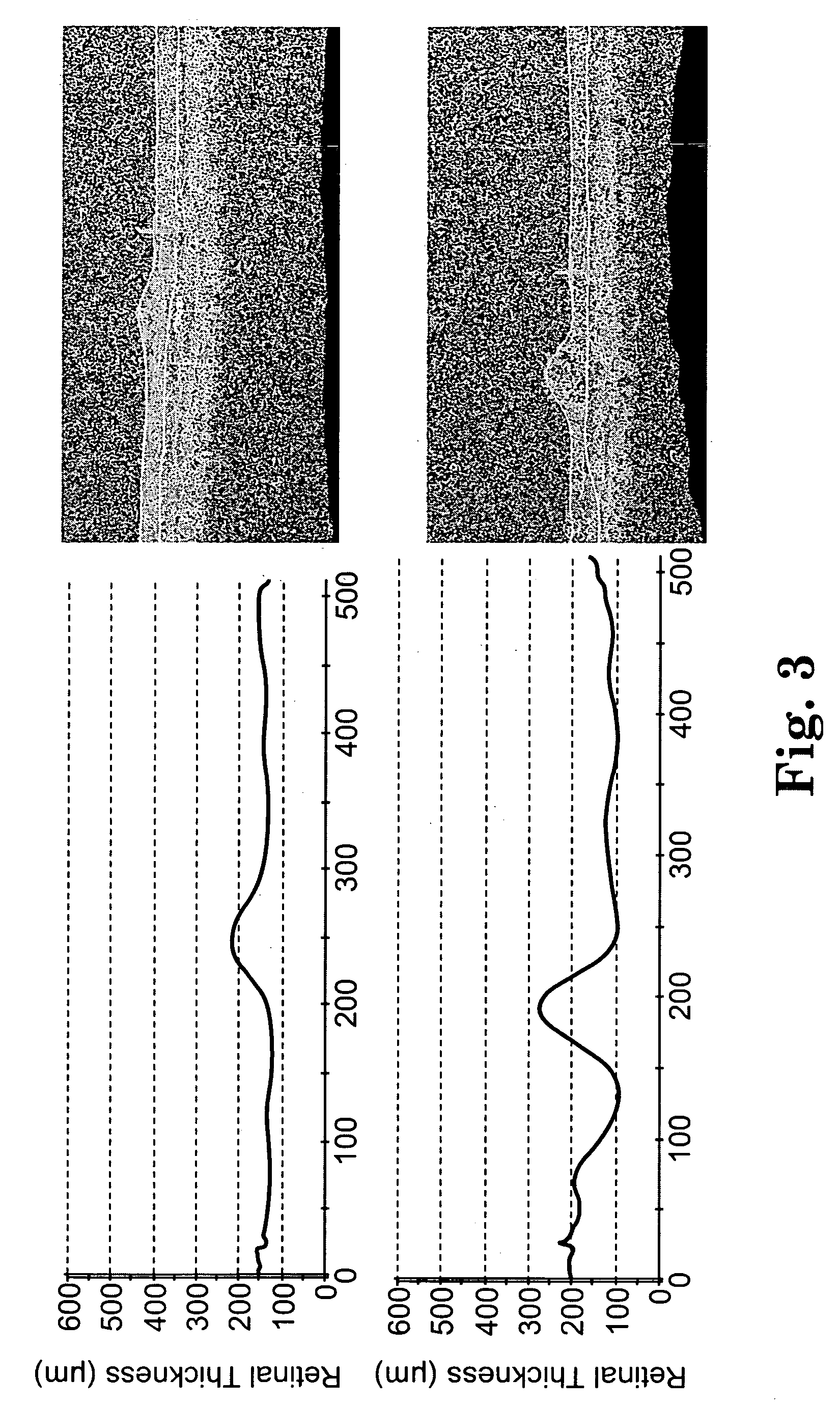 Sustained release implants and methods for subretinal delivery of bioactive agents to treat or prevent retinal disease