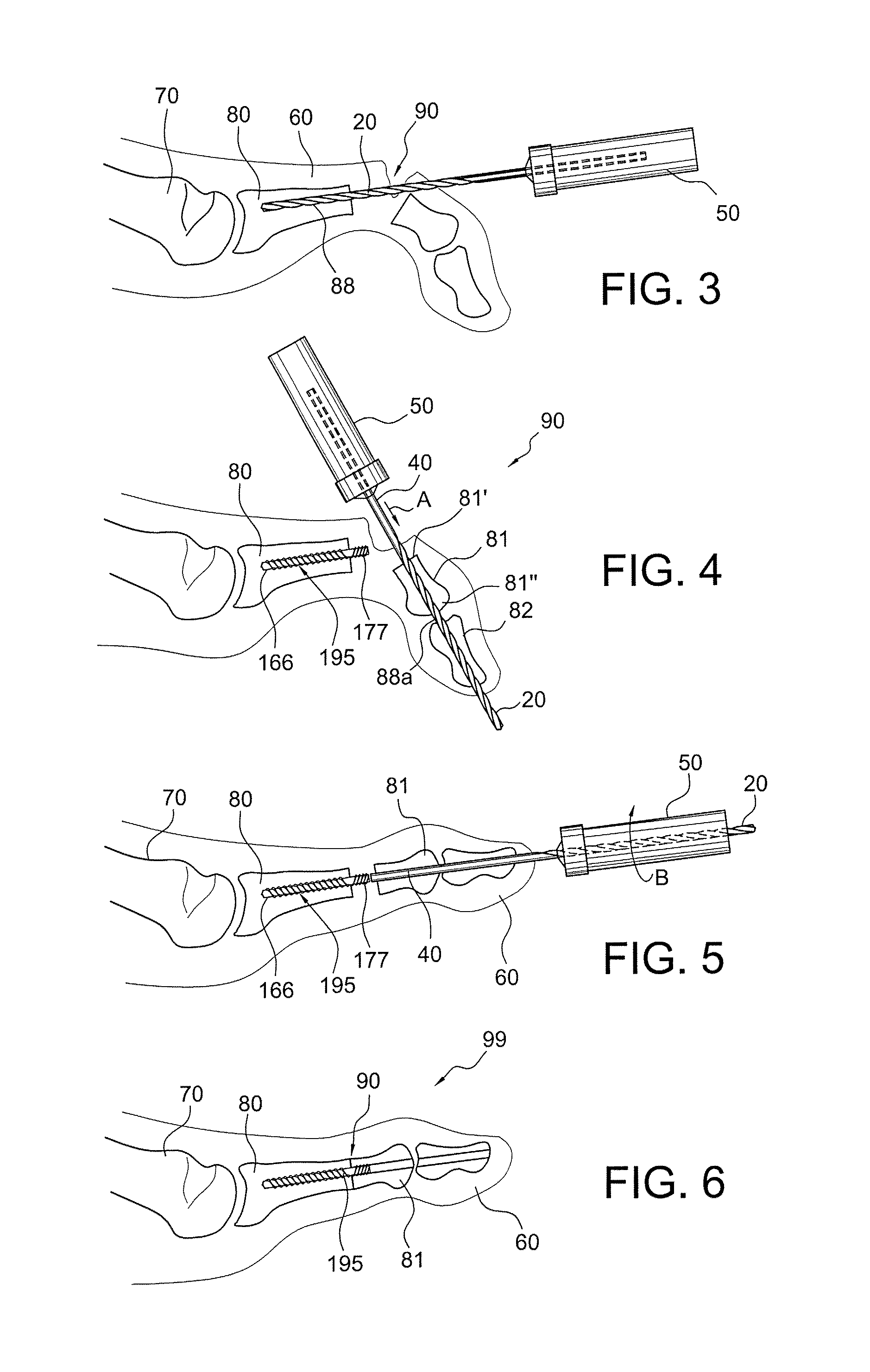 Drill/driver hybrid instrument for interphalangeal fusion