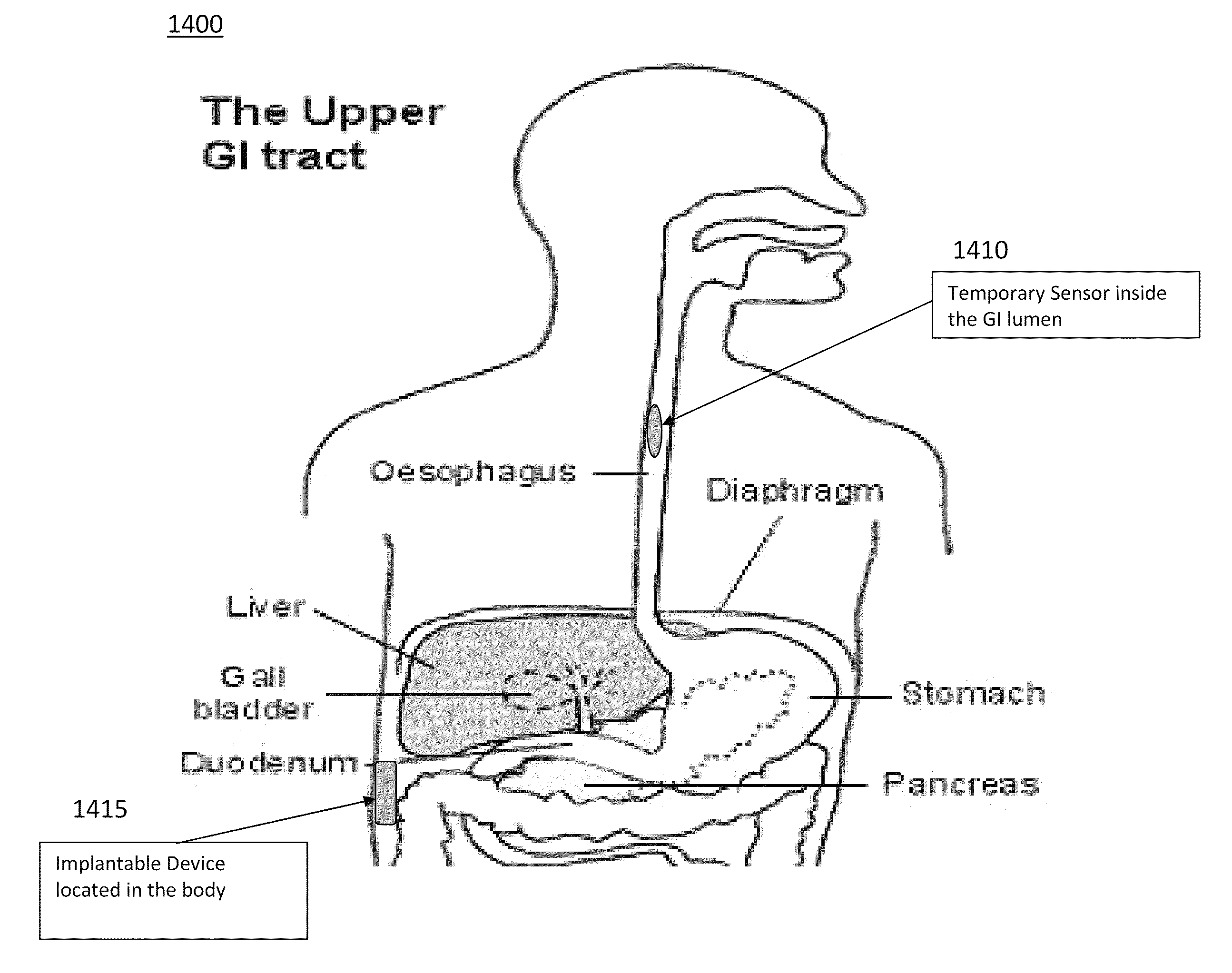 Device and implantation system for electrical stimulation of biological systems