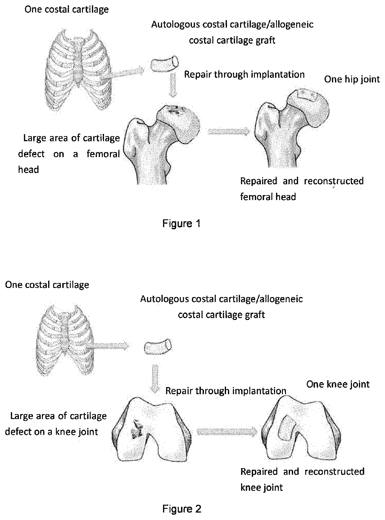 Graft for repairing articular cartilage defects and method for the same