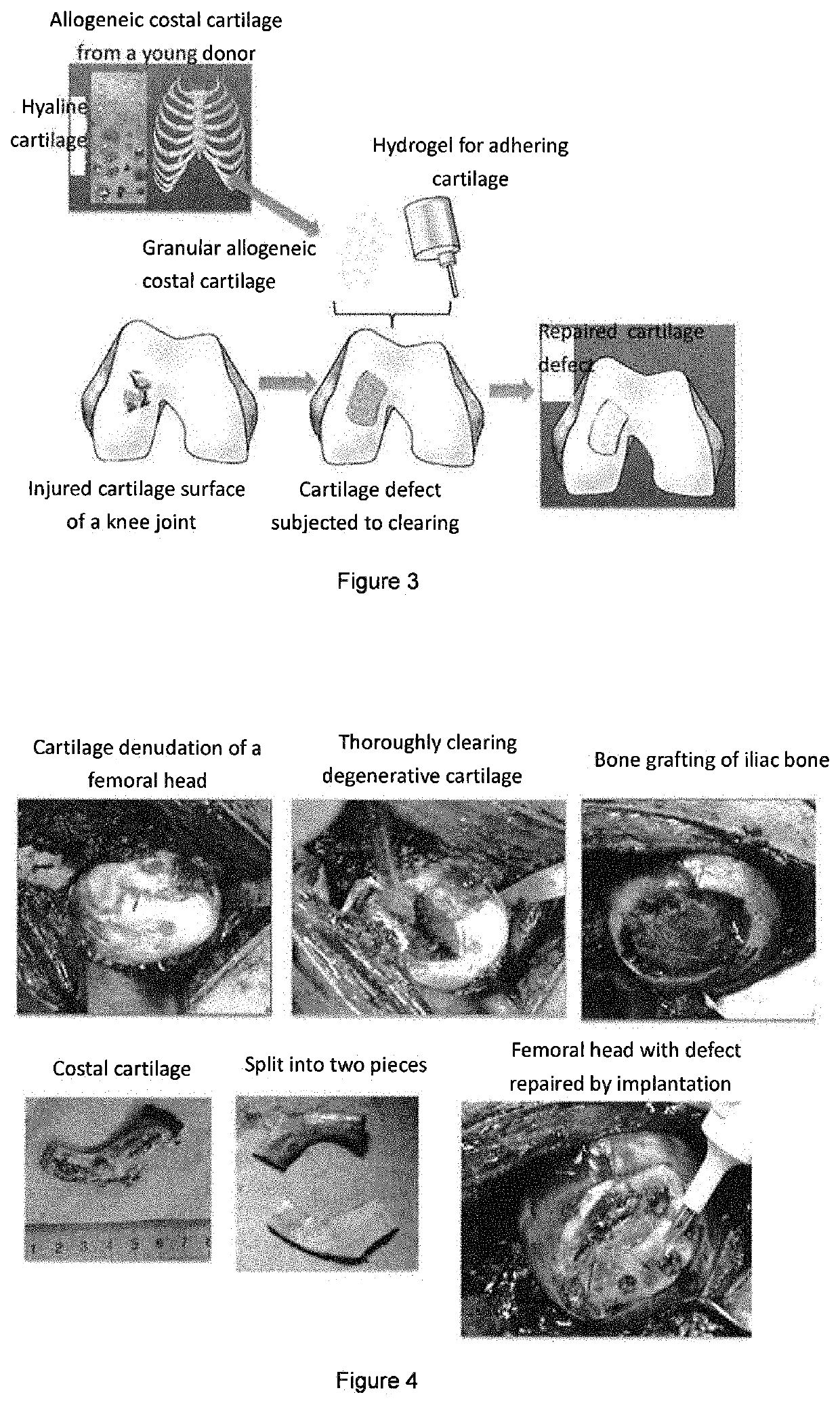 Graft for repairing articular cartilage defects and method for the same