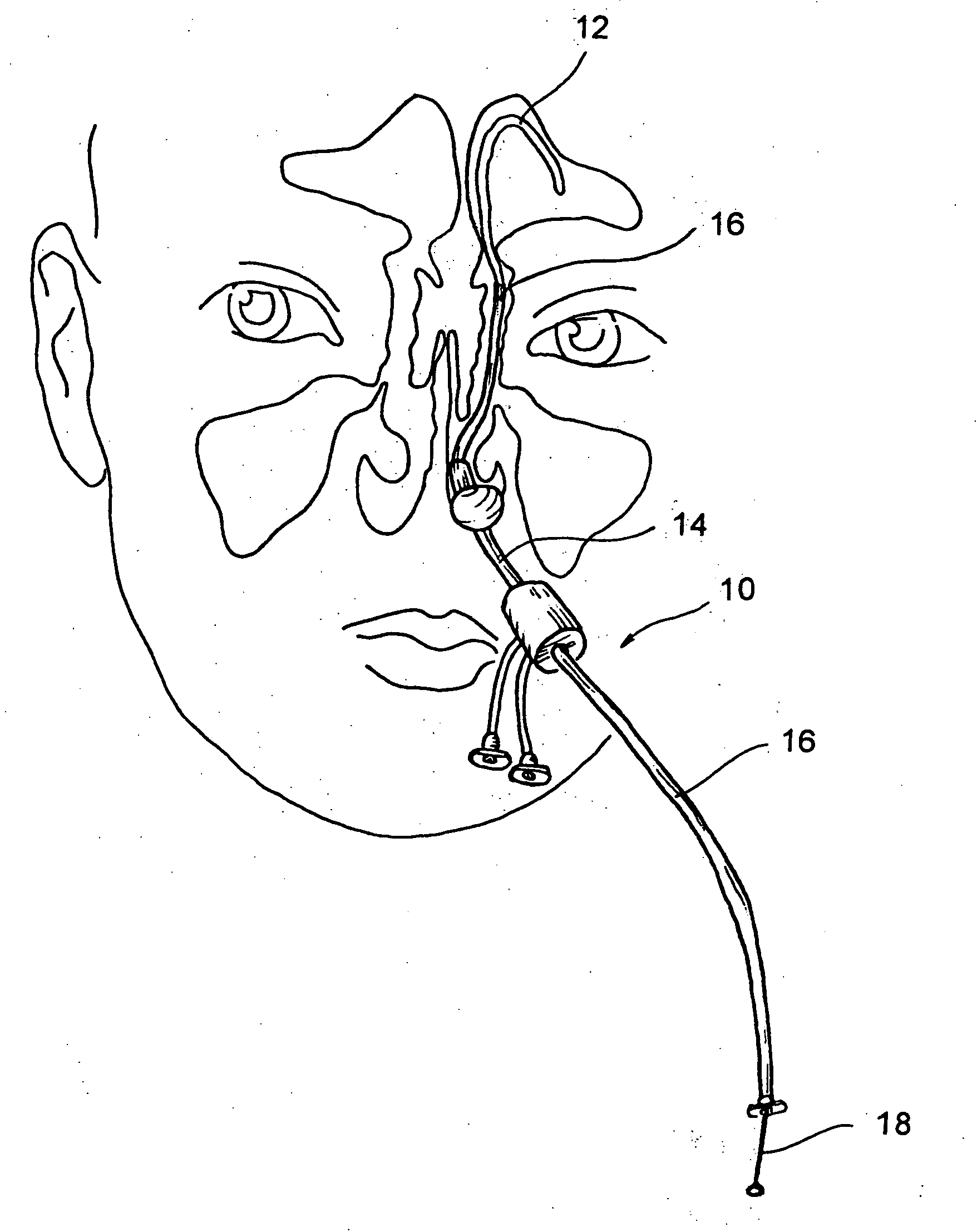 Implantable device and methods for delivering drugs and other substances to treat sinusitis and other disorders