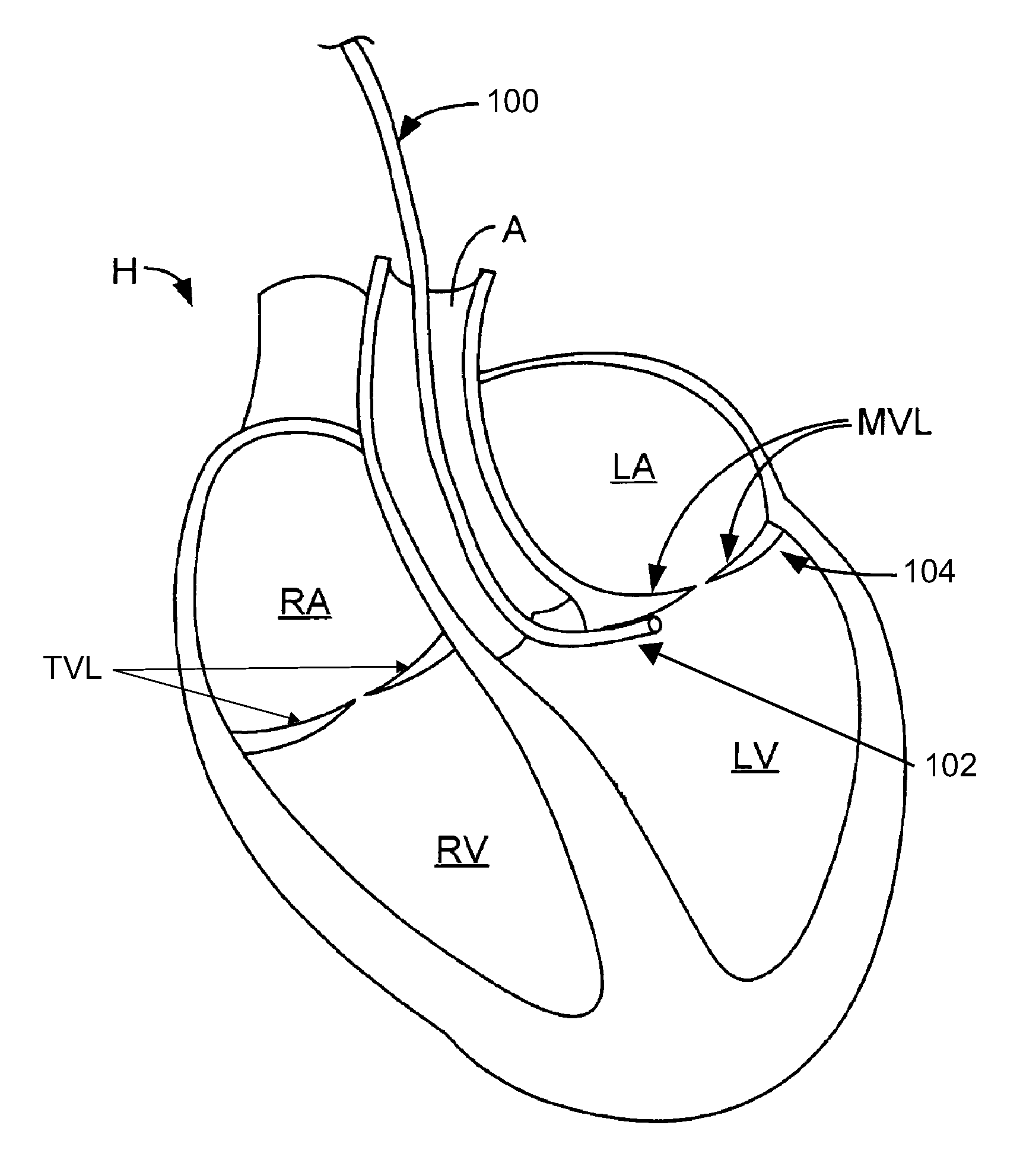 Systems and methods for cardiac remodeling