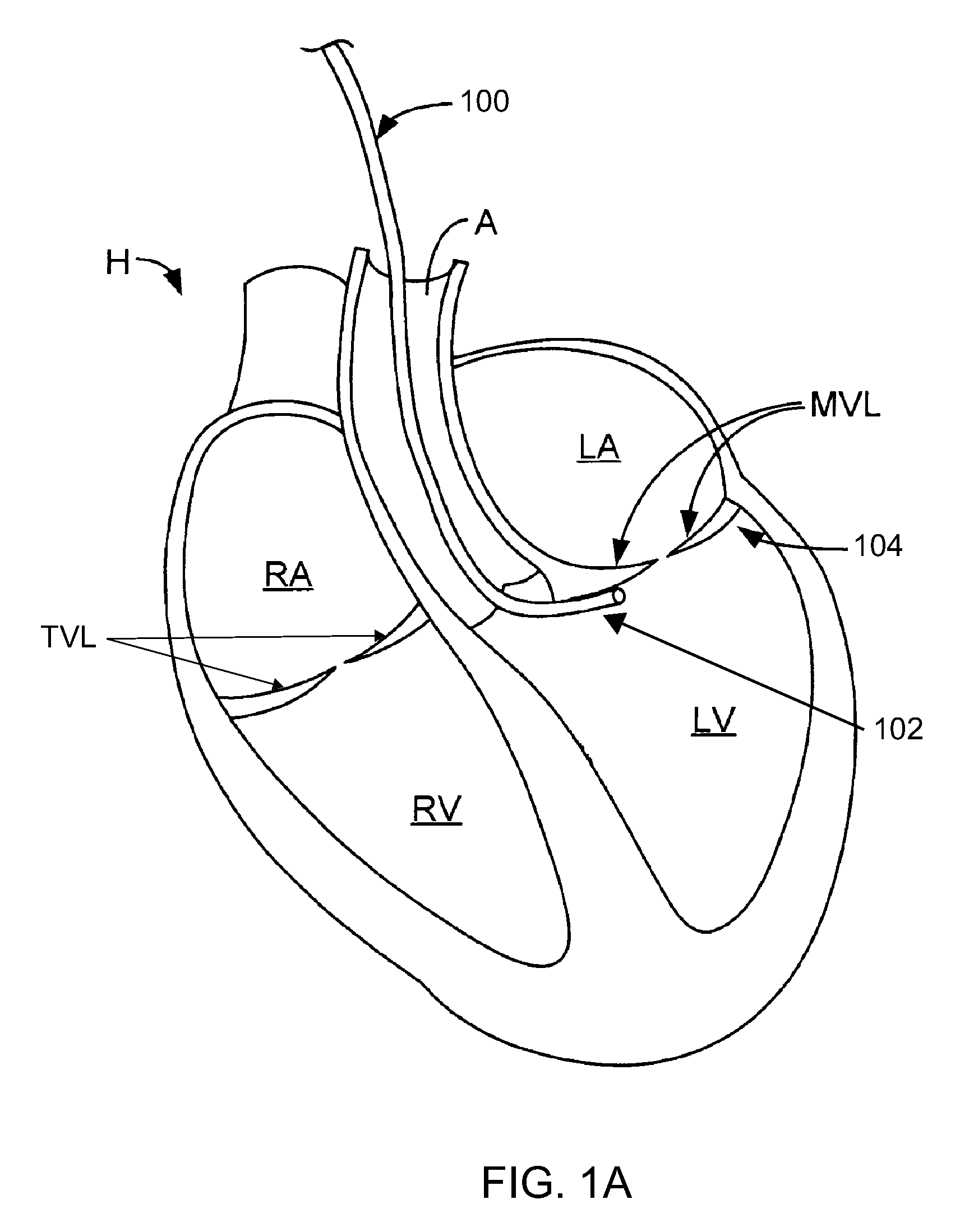 Systems and methods for cardiac remodeling
