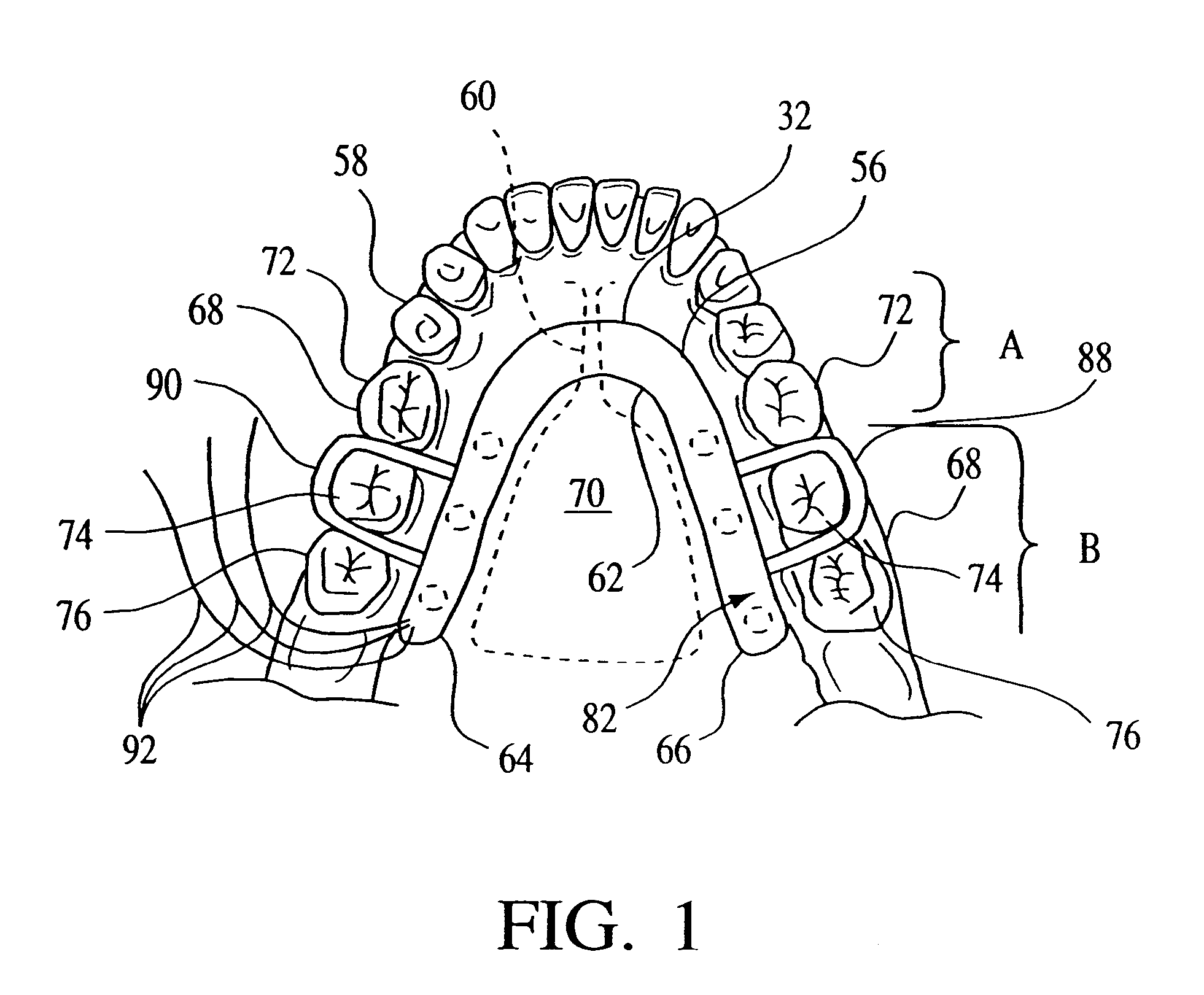 Intraoral electromuscular stimulating device and method