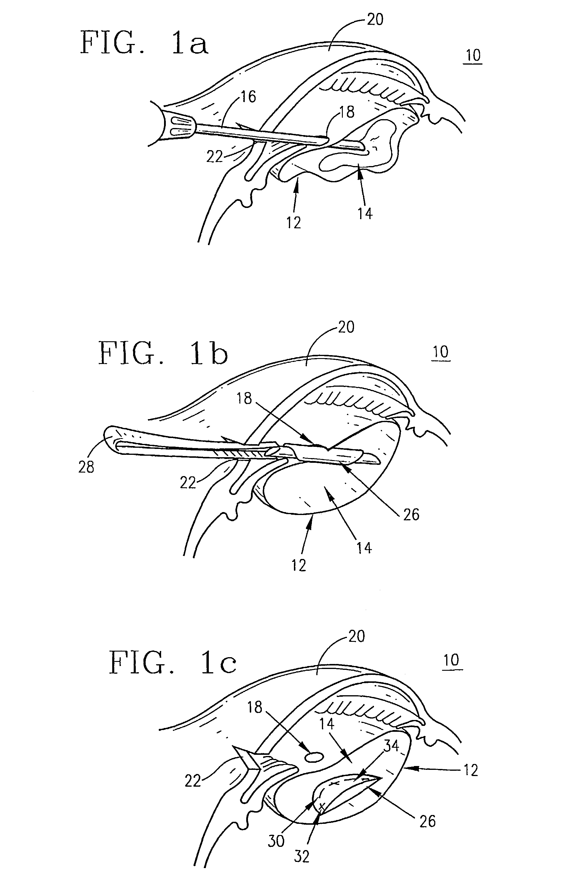 Supplementary endo-capsular lens and method of implantation
