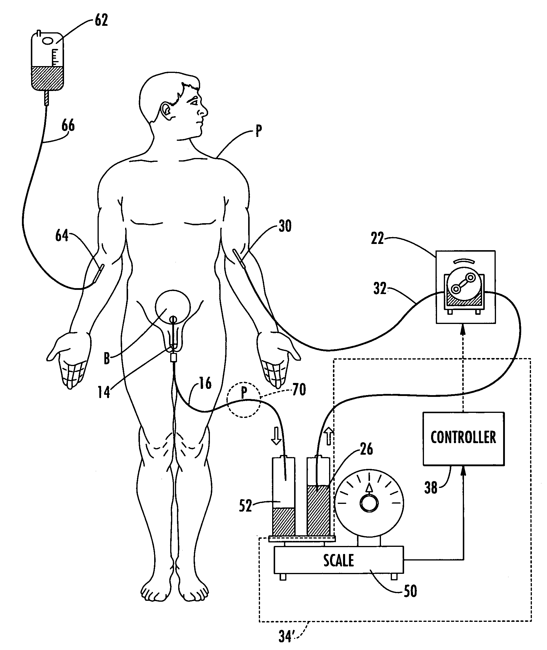 Patient hydration system with a redundant monitoring of hydration fluid infusion