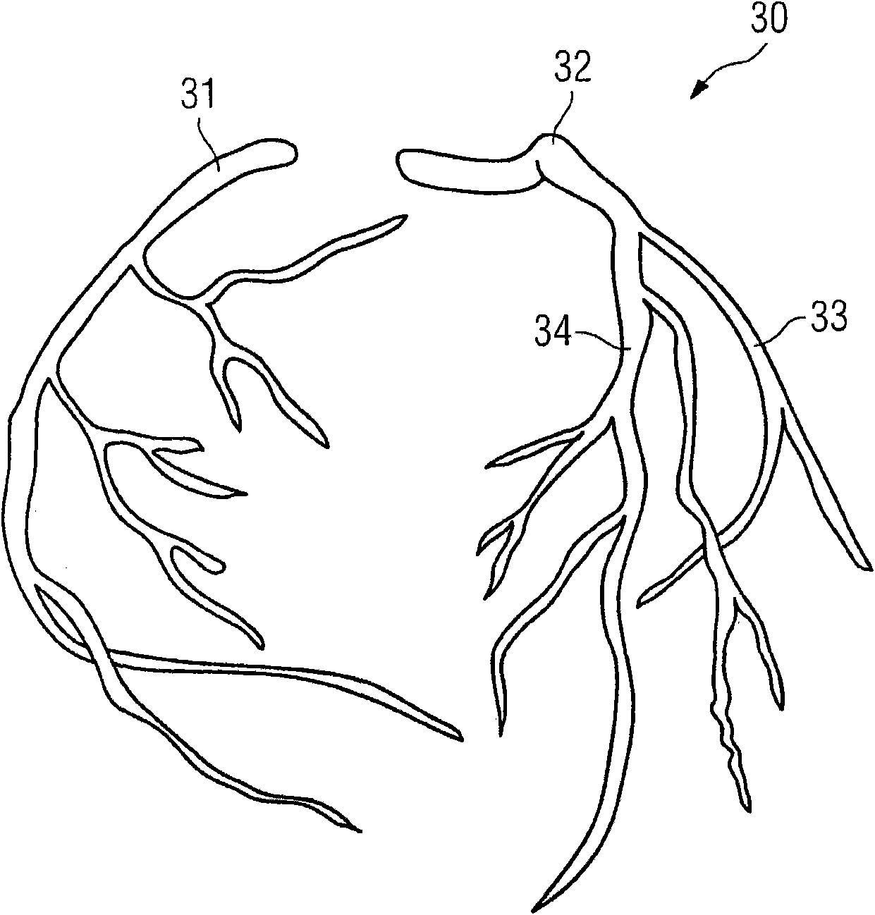 Method and device for identifying and assigning coronary calcification to a coronary vessel and computer program product